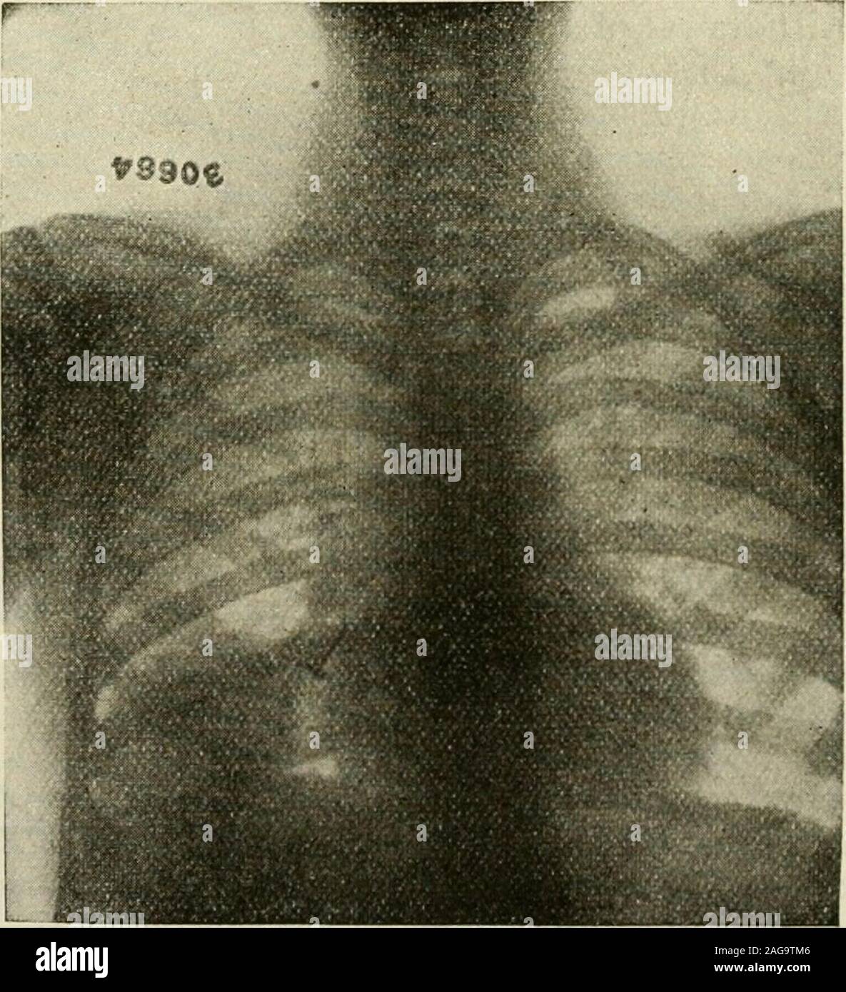 . Modern surgery, general and operative. Fig. 632.—Large fence staple
