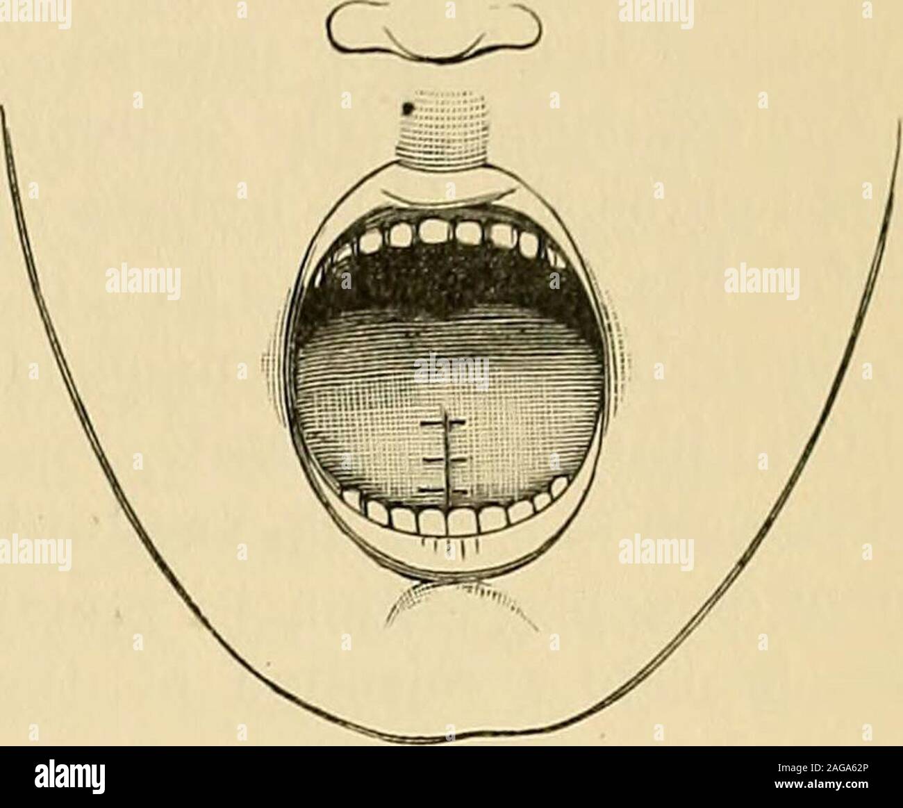 Operative Surgery Fig 818 Removal Of V Shaped Piece Fig 819 Flaps United And Forward Through One Border Of The Tongue Check The Points Of Severehemorrhage With Forceps Make The Division On The Opposite