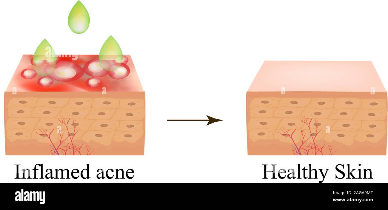 Acne treatment with acid peeling. Inflamed acne skin. Pimple inflamed
