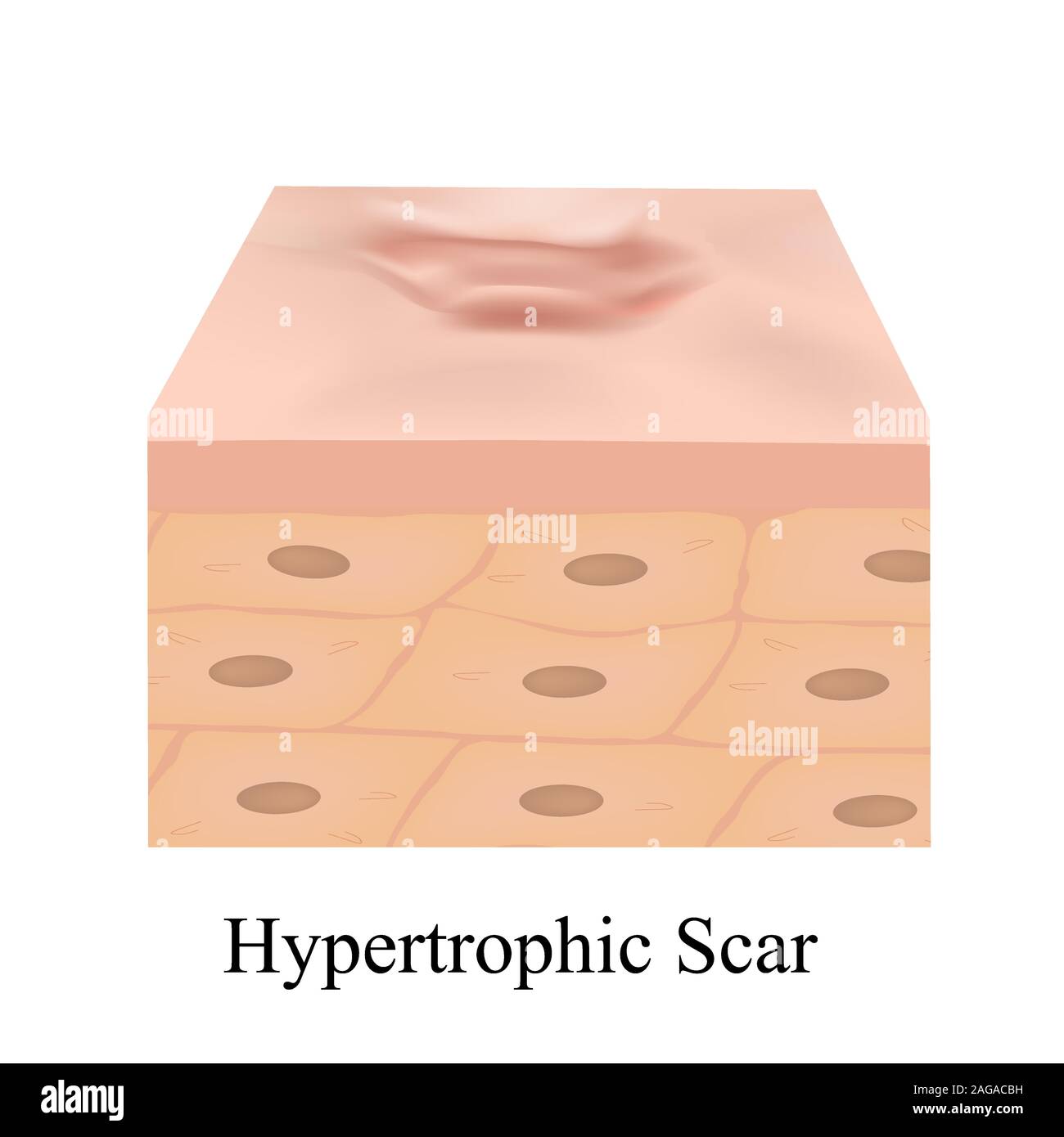 Scars hypertrophic. The anatomical structure of the skin scar. Vector