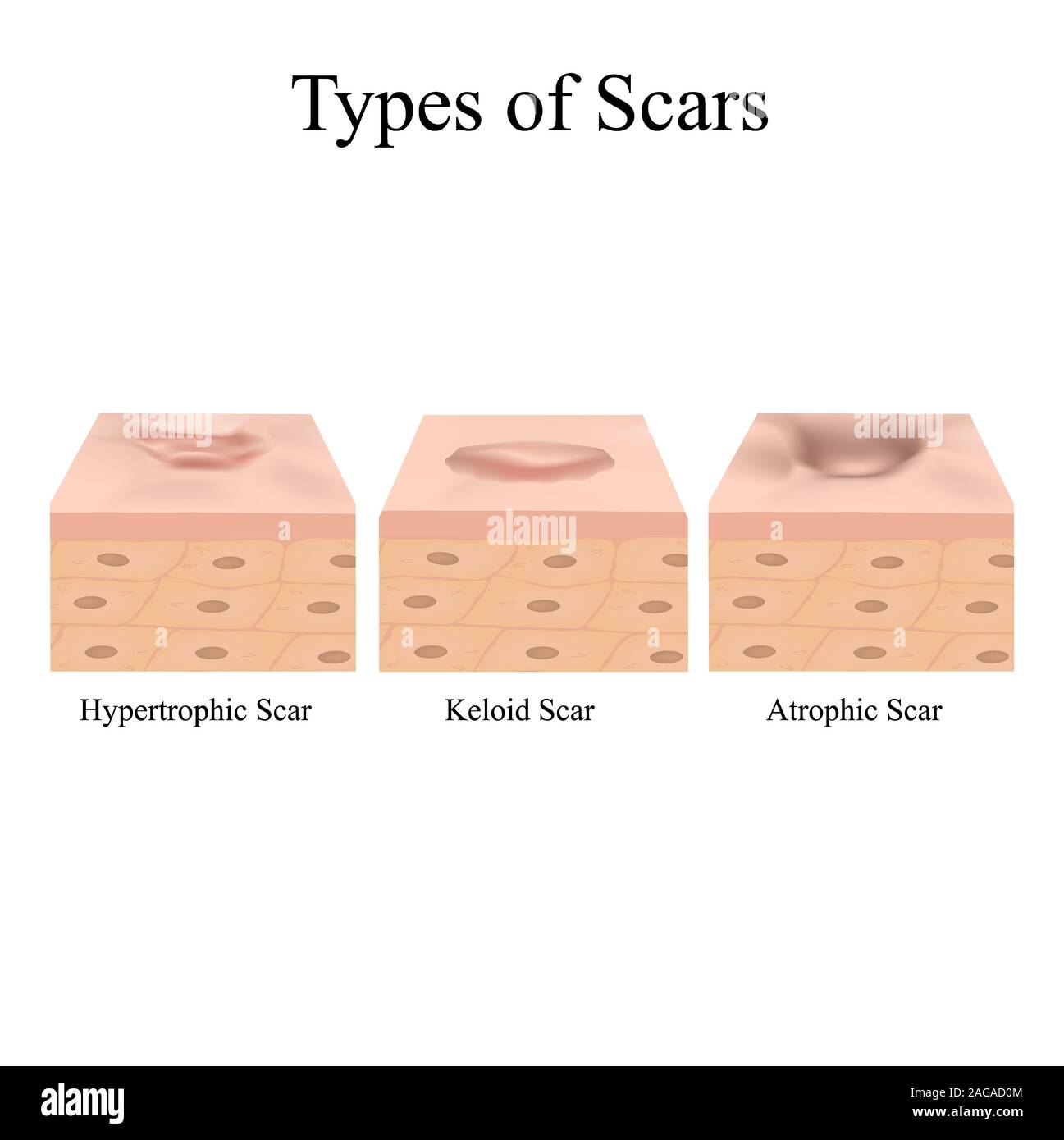 Keloid Scar From Acne