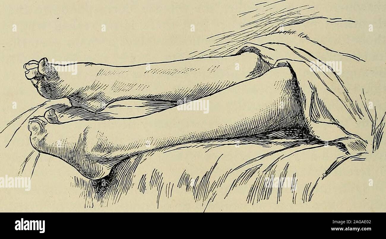 . A treatise on the nervous diseases of children : for physicians and students. laterally ; the foot is in thecondition of a pes cavus. The toes are hyperextended andhave a claw shape. This deformity of the toes is said tohave been observed as one of the early symptoms by parentsin whose families this special disease has been hereditary. * Some of these may belong to the Heredo-ataxie cerebelleuse of Marie. 382 THE NERVOUS DISEASES OF CHILDREN. Muscular atrophy constitutes an important symptom ofthis disease. It is most distinctly visible in the shoulderand pelvic girdles. It was so prominent Stock Photo