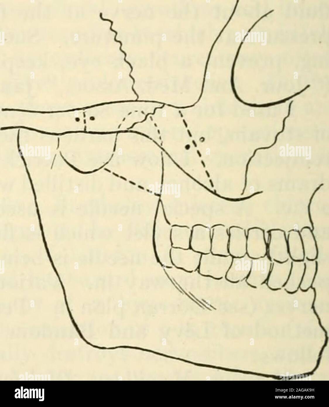 . Modern surgery, general and operative. Fig. 558.—a, The Braun-Lossen in-cision; c, Roses incision for reacliing thesphenomaxillary fossa (Rose). Fig. 559.—Lower jaw and zygoma.Drill-holes and saw-cuts are shown(Rose). exposes the pterygomaxillary fossa. The internal maxillary artery is ex-posed, two ligatures are applied, and the vessel is divided between them.The finger feels for the sphenomaxillary and pterygomaxillary fissures. Theexternal pterygoid muscle is separated from the greater wing of the sphenoidand from the root of the external pterygoid process. On the edge of the greaterwing Stock Photo