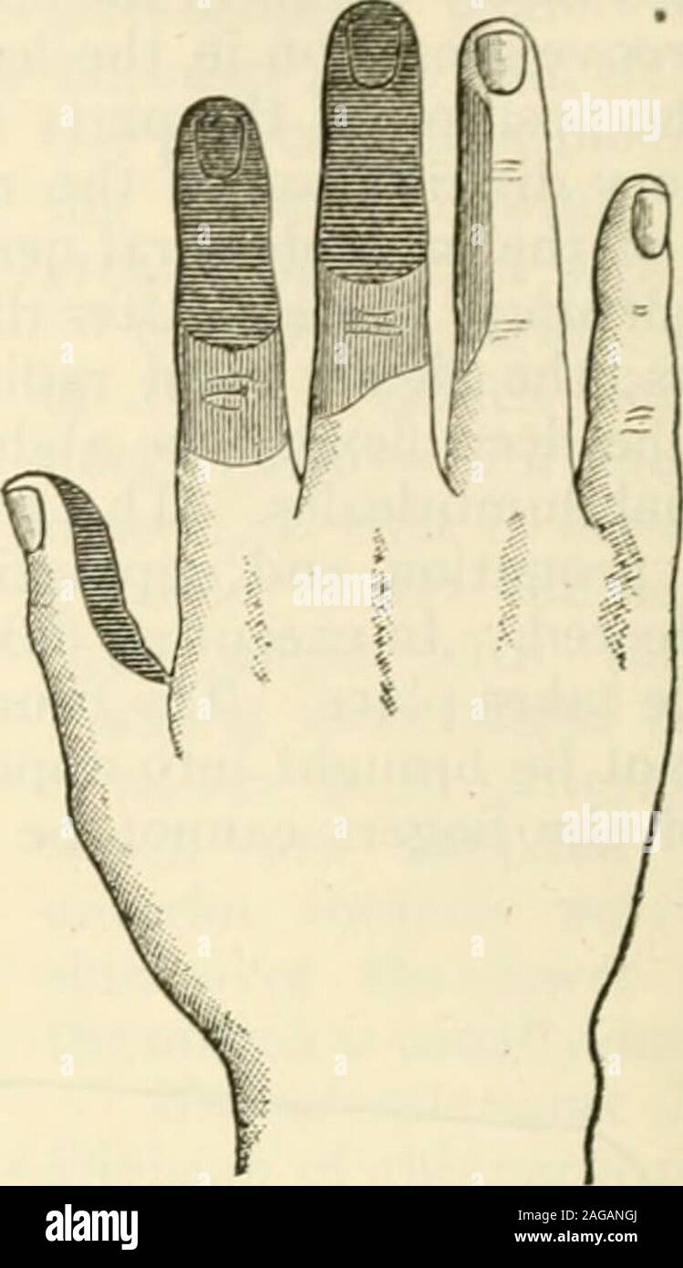 . Modern surgery, general and operative. Fig. 548.—Section of median