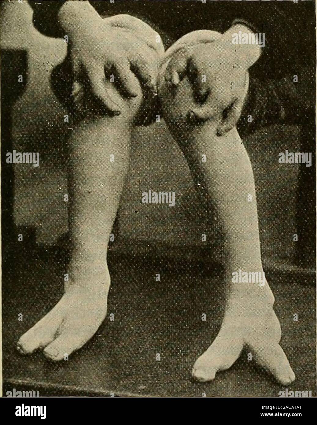 Talipes Valgus High Resolution Stock Photography And Images Alamy Talipes Valgus High Resolution Stock Photography And Images Alamy