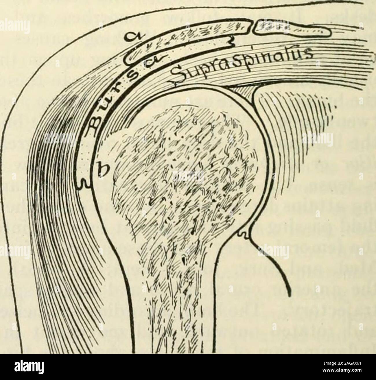 Modern surgery, general and operative. hose about the hip,the subdeltoid,  the olecranon, theprepatellar, and the retrocalcaneal.In tuberculous  bursitis during thefirst stage the bursa is distendedby fluid, due to  oversecretion, thewalls are