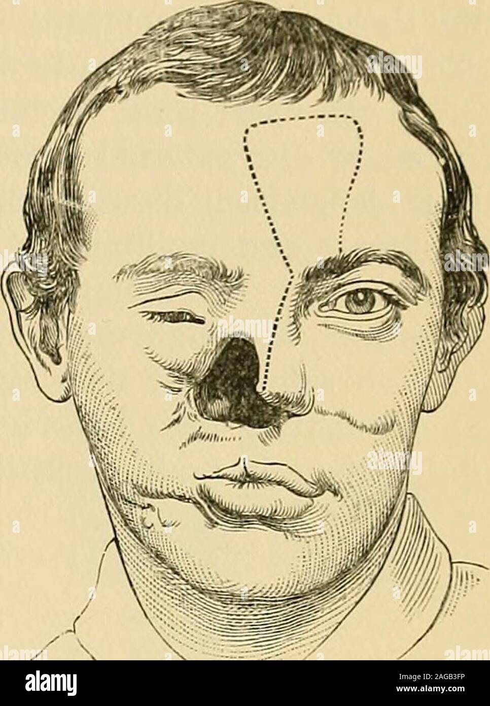 . Operative surgery. Fig. 726.—Bucks method. Fig. 727.—Bucks method. After the edges of the defect are freshened, the flap is slid carefully intothe gap and united there with horsehair sutures. Weher cured a defective ala with a flap taken from the upper lip, thepedicle being continuous with the columna. The flap was oval, included aportion of the thickness of the lip only, and was slid into the gap andunited with its freshened borders by horsehair sutures. At the end of fourweeks the pedicle was divided and turned upward to improve the sym-metry of the nose. If either ala be absent, and the r Stock Photo