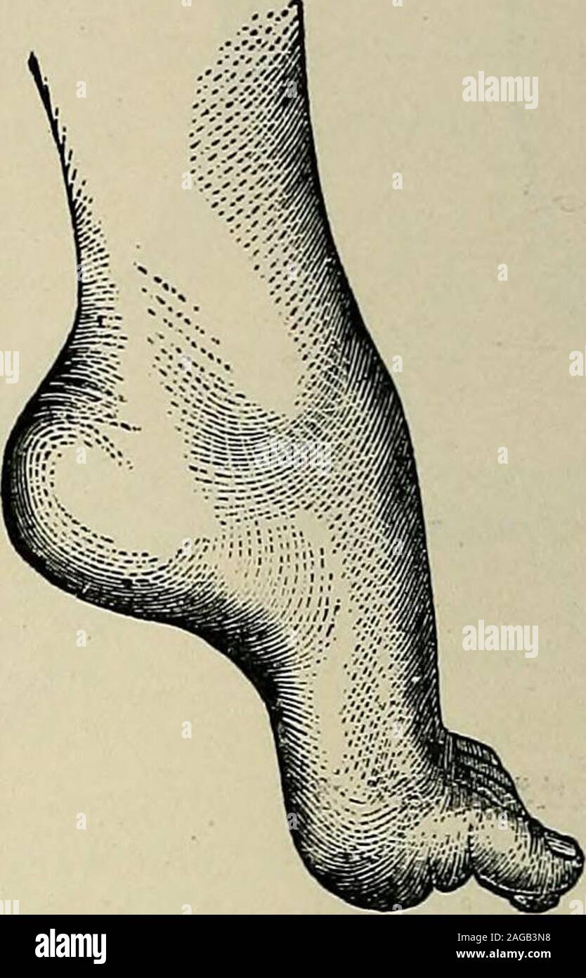 . A treatise on the nervous diseases of children : for physicians and students. Fig. 26. — Pes Equinus in a BoyFive Years of Age from Atropliyof Tibialis Anticus.. Fig. 27. — Pes Equinus ofEight Years Duration. Tibialis AnticusExtensor Digit. Commun. Longus. Peroneus Brevis Extensor Hallucis Longus Dorsal Interossei Stock Photo