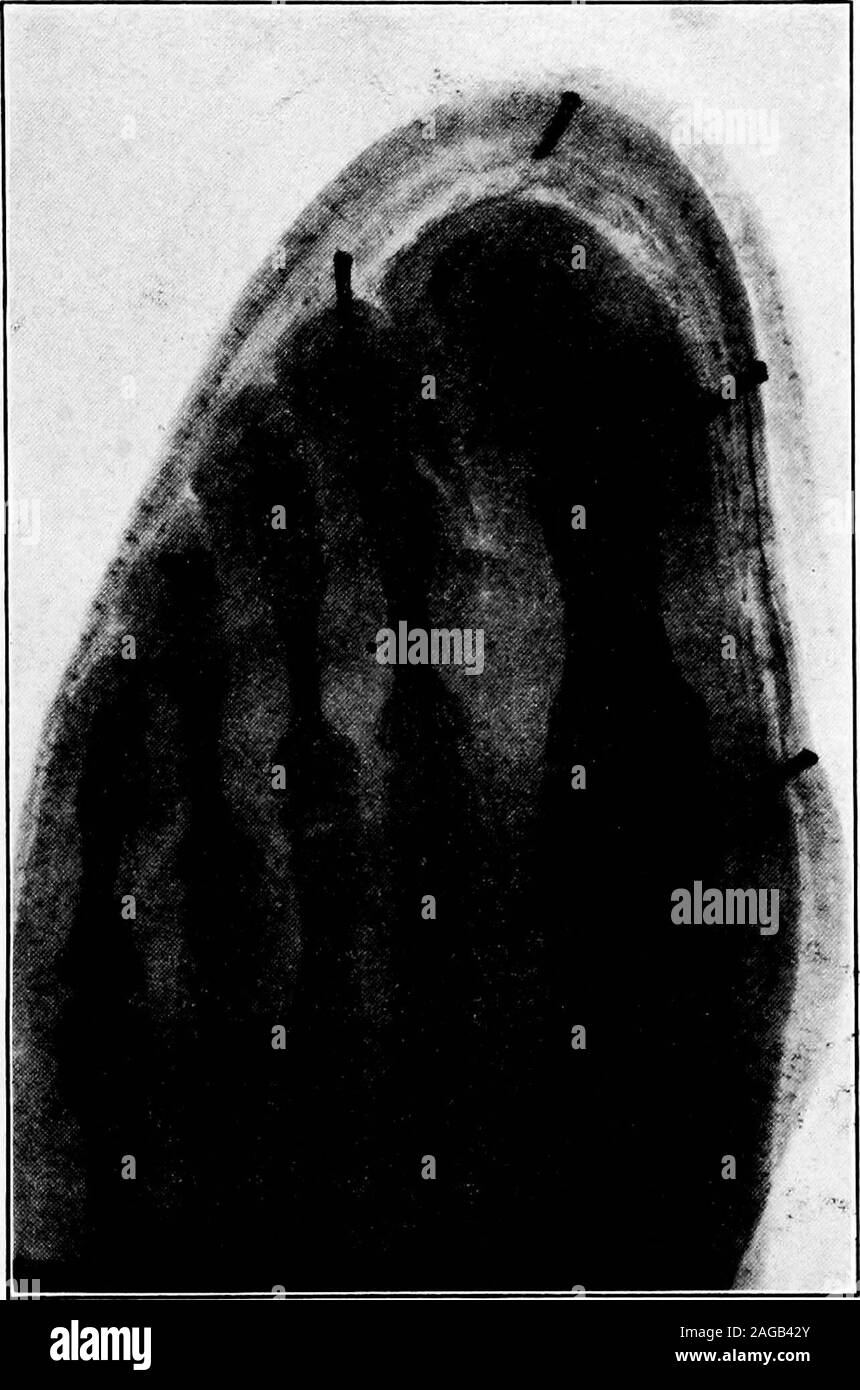 . A manual on foot care and shoe fitting for officers of the U.S. Navy and U.S. Marine corps. EOOT IN CrVILLIAN LAST lOS. Fig. 46.—Foot in ordinary civilian or so-called English last. Note thelessened width and length restricting toe action. (X-ray photograph.) io6 FOOT CARE AND SHOE PITTING Stock Photo