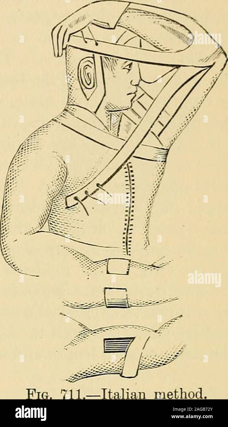 . Operative surgery. he wisdom of acontinuance, and the belief that important practical benefits may arise fromthe labor. Shin-grafting is practiced for the purpose of causing the healing of freshand granulating surfaces of larger or smaller size. It is essential to successthat the granulations be healthy and that aseptic care be exercised in theperformance of the grafting. Three methods of procedure are now wellrecognized : one, the oldest, Reverdins method, the others and the moremodern, Thierschs and Krauses methods. Reverdins method is performed by first making small punctures inhealthy gr Stock Photo