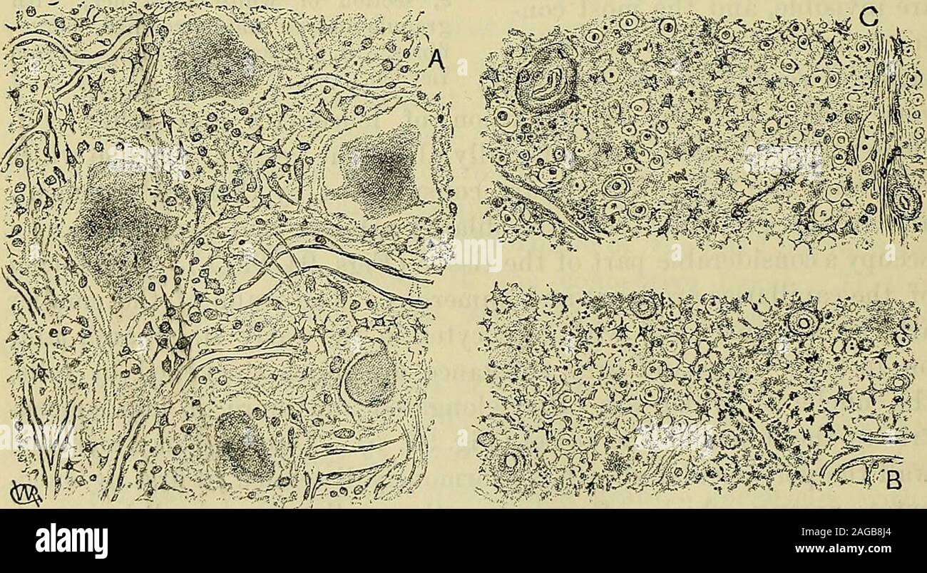 . A manual of diseases of the nervous system. Fia. 94.—Subacute ...