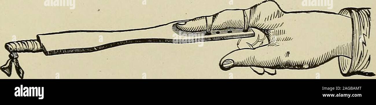 . Modern surgery, general and operative. Fig. 469.—^Leviss splint for reducing dislocation of phalanges. eighth, ninth, and tenth) may be separated. The inferior cartilage goes for-ward and can be felt. Pick states that reduction is brought about by causingthe patient to hold the chest full of air while efforts are made to push the car-tilage into place. The injury is dressed as are fractured ribs (see page 624).Dislocation of the Sternum.—In dislocation of the body of the sternumthe manubrium is separated from the gladiolus. The injury is a rare one, isusually associated with fracture, and is Stock Photo