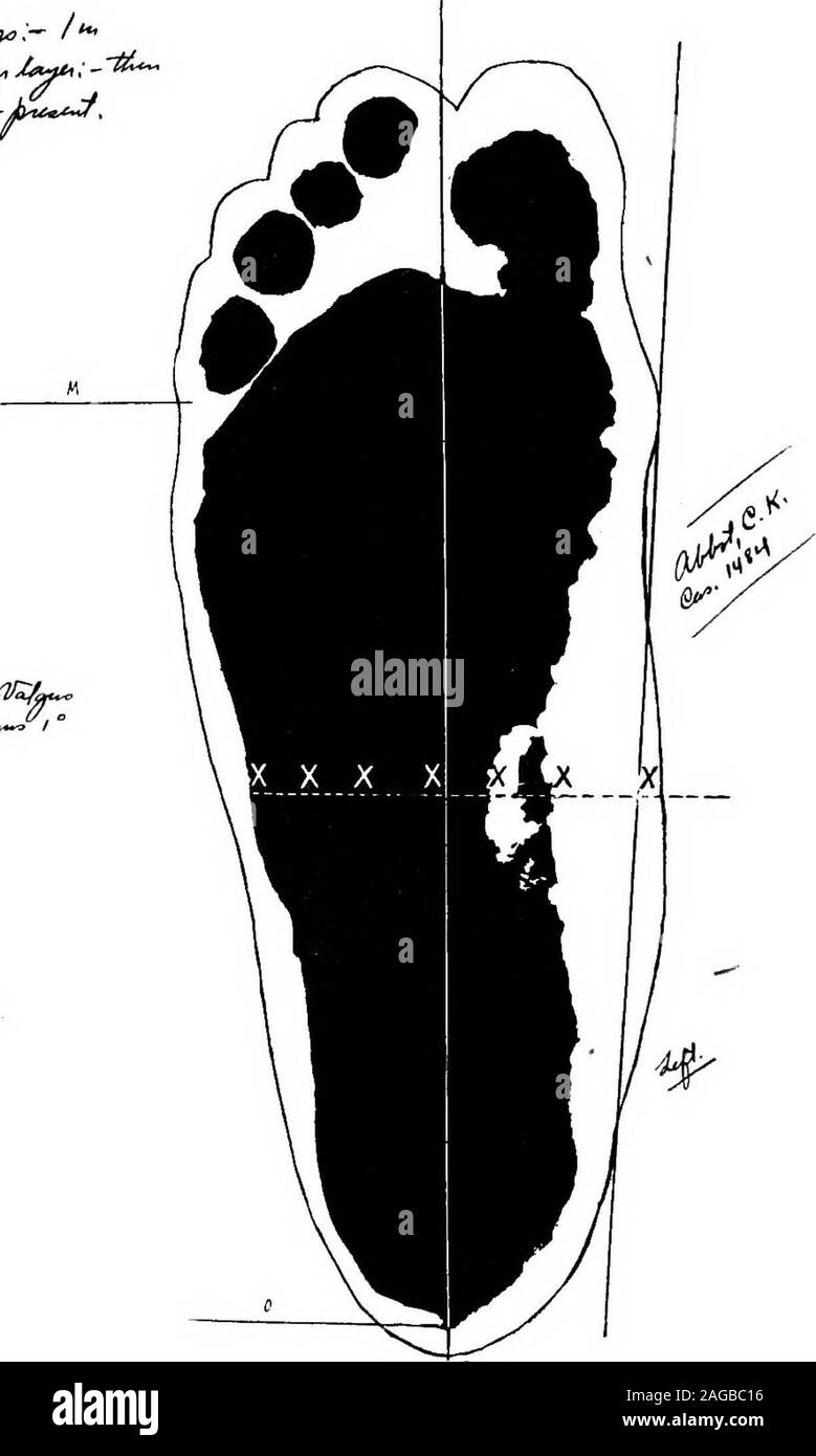 Pes planus flat foot Cut Out Stock Images & Pictures Alamy