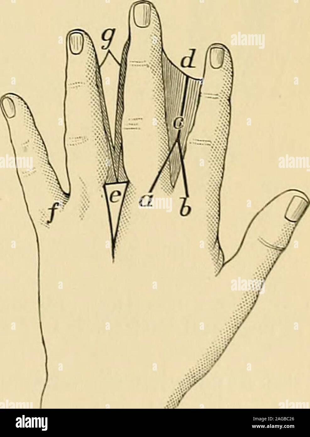 Crippled fingers hires stock photography and images Alamy