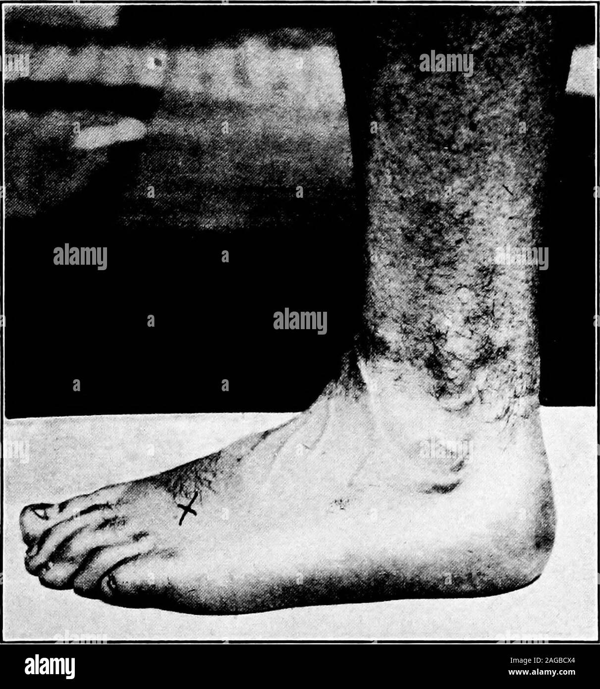 . A manual on foot care and shoe fitting for officers of the U.S. Navy and U.S. Marine corps. nd cold water. 3. Correct walking posture; the feet parallel in standingand walking. 4. Feet measured and shoes fitted. 5. Foot exercises. 6. Strapping of the feet which should be done or supervisedby the Medical Officer. 7. Shoe alterations to shift the misplaced weight where itnaturally belongs. 8. Arch supports should not be worn for this condition asthey tend to decrease the muscular power of the soles of thefeet. PES CAVUS (Hollow-foot) It is important that this condition, heretofore conspicuousl Stock Photo