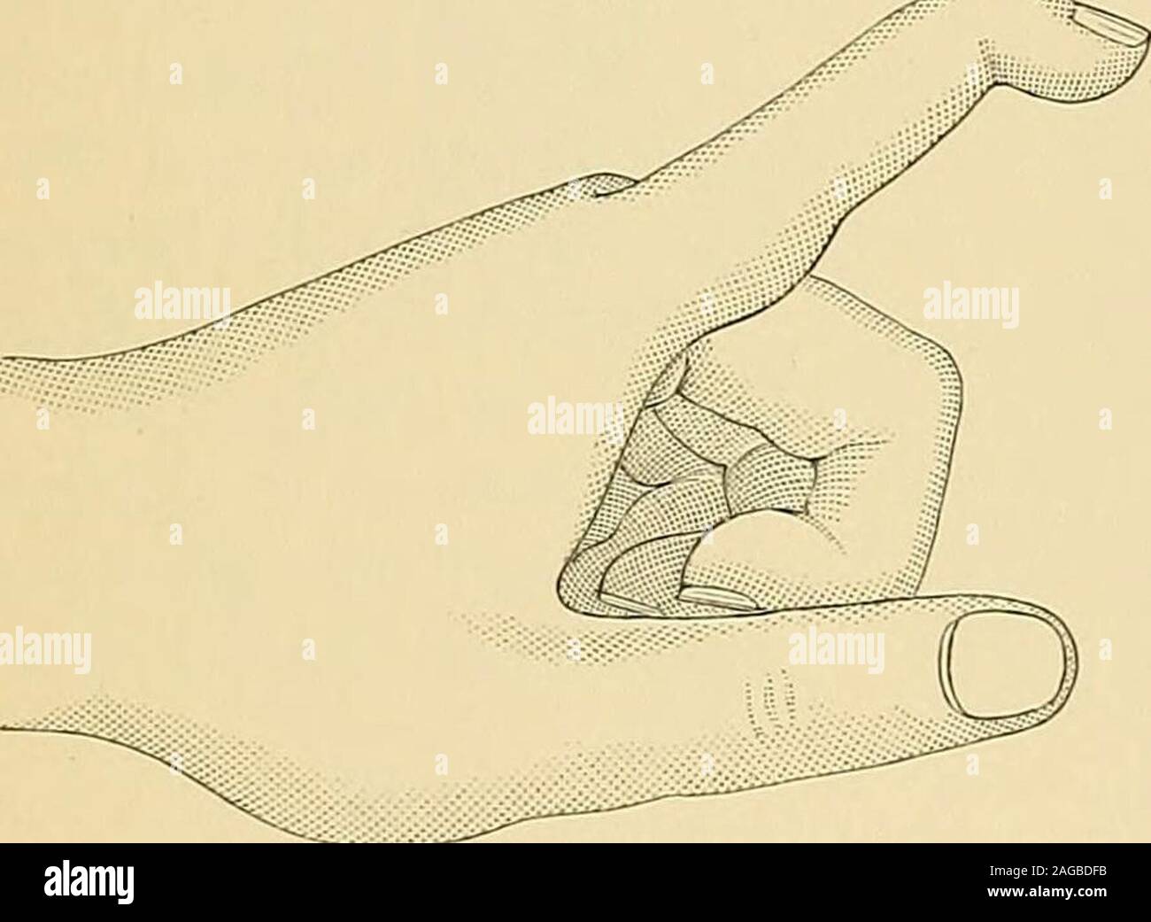 . Operative surgery. e distal phalanx througha longitudinal incision ...