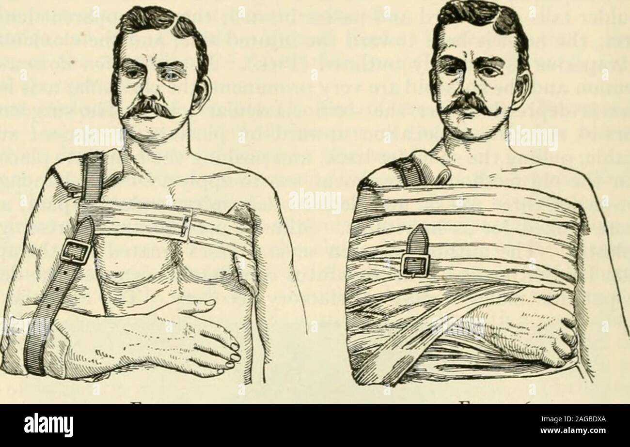 . Modern surgery, general and operative. ent, and sutur-ing the acromion to the outer end of the clavicle. The bones are sutured withsilver wire or kangaroo tendon, the acromioclavicular ligament is sutured withcatgut, the wound is closed with sutures of silkworm-gut, and the patient iskept supine in bed for three weeks. I have operated successfully on 5 of thesecases. Dislocation downward is reduced and treated in the same manner as dis-location upward. Simultaneous dislocation of both ends of the clavicle is a very rare injury. Itis treated as is single dislocation. The so-called dislocation Stock Photo
