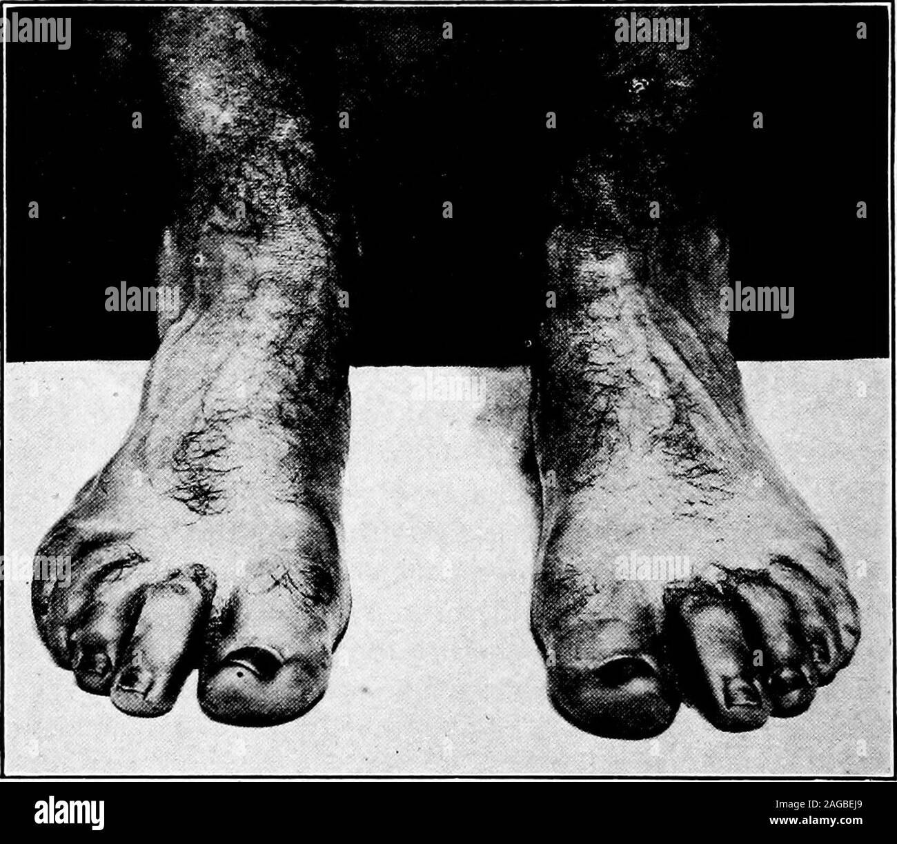 . A manual on foot care and shoe fitting for officers of the U.S. Navy and U.S. Marine corps. elling but extrene tenderness is found at the attachmentof the heel tendon into the heel bone and may involve thesurrounding bone. Exostoses may or may not be felt. Diag-nosis usually made by x-Ta.y, chronicity and previous historyof gonorrhea. Treatment. Remove primarily the excessive pressure or fric-tion by new shoes or leggins or adjustment or the same. Strappads of felt or cotton to the leg just above toe point involvedwhen the tendon is affected and just below when the bursa ortendon attachment Stock Photo