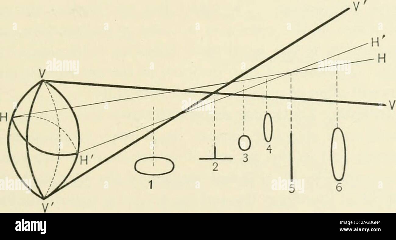 . Refraction and how to refract : including sections on optics, retinoscopy, the fitting of spectacles and eye-glasses, etc.. peropic eyes are seen, yetstatistics show that fully eighty per cent, of hyperopic eyeshave astigmatism. Astigmatism is located in the cornea or lens, or it may bea condition of both structures in one and the same eye.Astigmatism of the lens may increase, diminish, or neutral-ize the corneal astigmatism. Astigmatism, however, ismore often a condition of the cornea than of the lens. Figure 93 shows parallel rays of light passing throughan astigmatic lens where the vertic Stock Photo