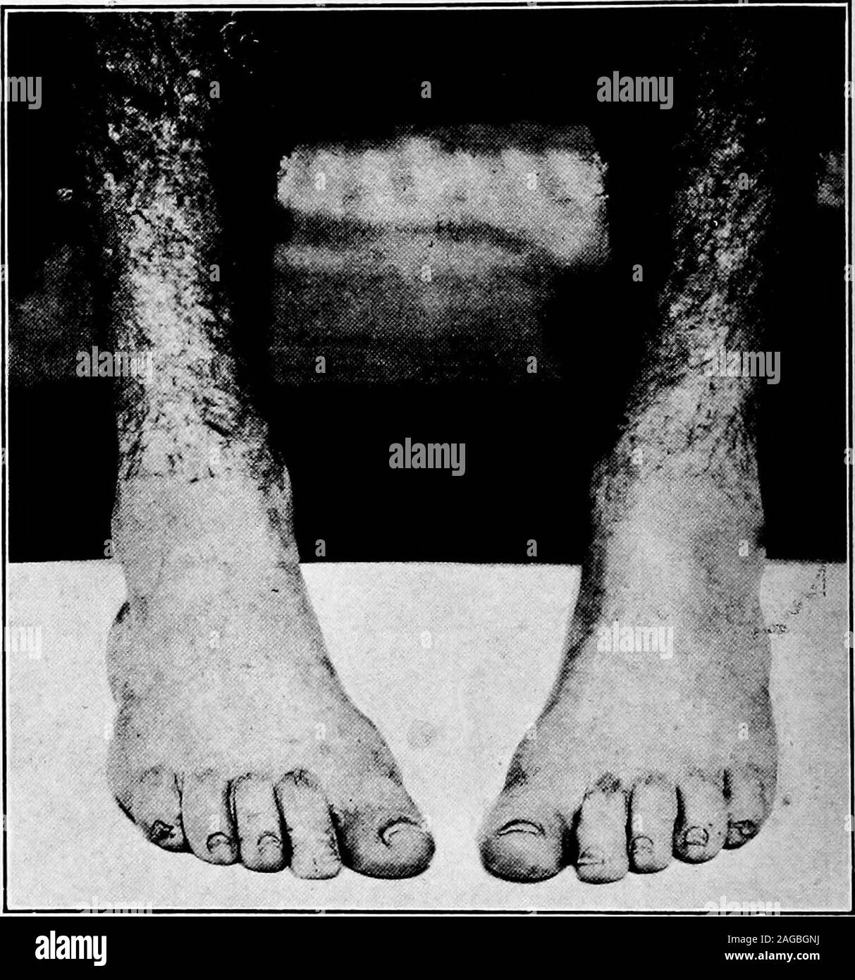 . A manual on foot care and shoe fitting for officers of the U.S. Navy and U.S. Marine corps. Fig. 7.—Correct foot posture. help him. The great majority of men come from sedentaryoccupations in civilian life and enter upon an active pedestrial i6 FOOT CARE AND SHOE FITTING life, when they enter the service; and we must realize theirshort-comings and strive to develop these men correctly ifgood results are to be accomplished. The greater part of the. Fig. 8.—Incorrect foot posture. Toeing in. Pigeon toed, responsibility of developing this raw material depends primarilyand essentially on the lin Stock Photo
