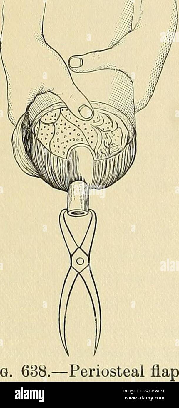 . Operative surgery. Pig. 637.—Celsuss single circular incision Stock ...