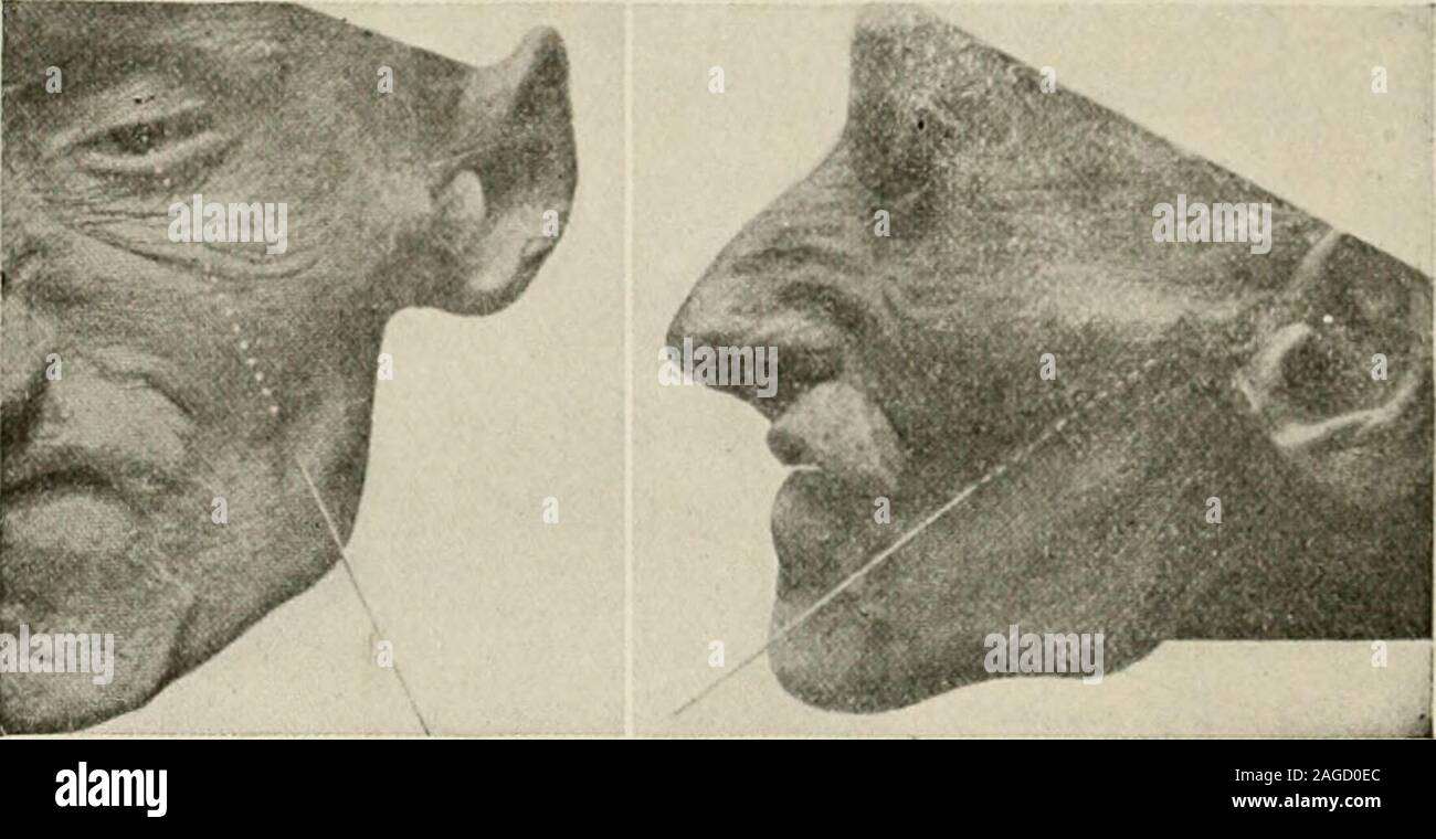 . Local and regional anesthesia; with chapters on spinal, epidural, paravertebral, and parasacral analgesia, and other applications of local and regional anesthesia to the surgery of the eye, ear, nose and throat, and to dental practice. Fig. 209.—Position and size of area of skin anesthesia for injection of gasserian ganglion. (Hartel.) outward, then upward and inward, traverses the canal of the foramenovale in diagonal direction, and thereby arrives in the direction of theinclination of the petrous portion of the temporal bone (Fig. 206,b, c, d). 584 LOCAL ANESTHESLA. Fig. 2IO.—Hartel route, Stock Photo