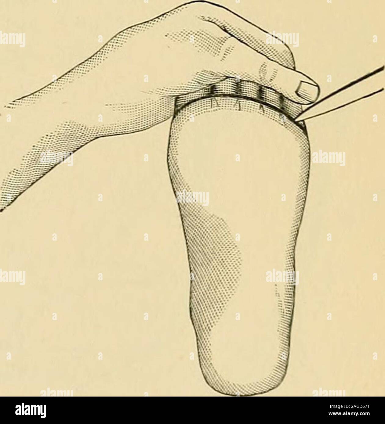 . Operative surgery. Fig. 561.—Incisionfor plantar flap. Fig. 562.—Stump ofinternal plantar flap. Pig. 563.—Amputation of all the toes, plantar incision. Amputation of all the Toes at the Metatarso-phalangeal Joints (Disar-ticulation).—Forcibly extend the toes with the left hand and make a curvedincision on the plantar surface from the inner side of the articulation of thegreat toe to the outer side of the corresponding joint of the little toe, carry-ing it through the groove between the sole of the foot and the bases of the 500 OPERATIVE SURGERY. toes (Fig. 562). Flex the toes and join the ex Stock Photo