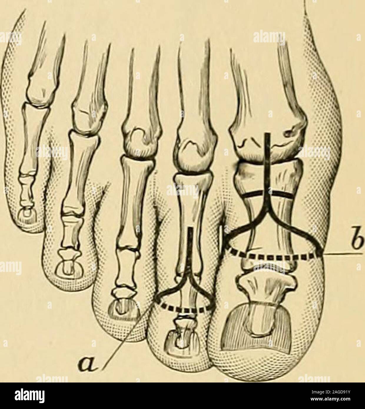 Racket Incision Toe Dorsum of fingers hi-res stock photography and images - Alamy