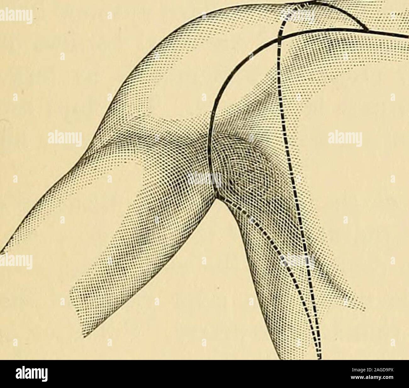 . Operative surgery. bone.It is then dissected up, the intervening