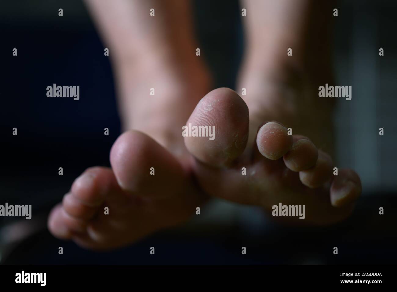 Close up of woman feet having tinea pedis althlete's fungus infection. Pathogenic infectious disease that can be easily acquired from contaminated flo Stock Photo