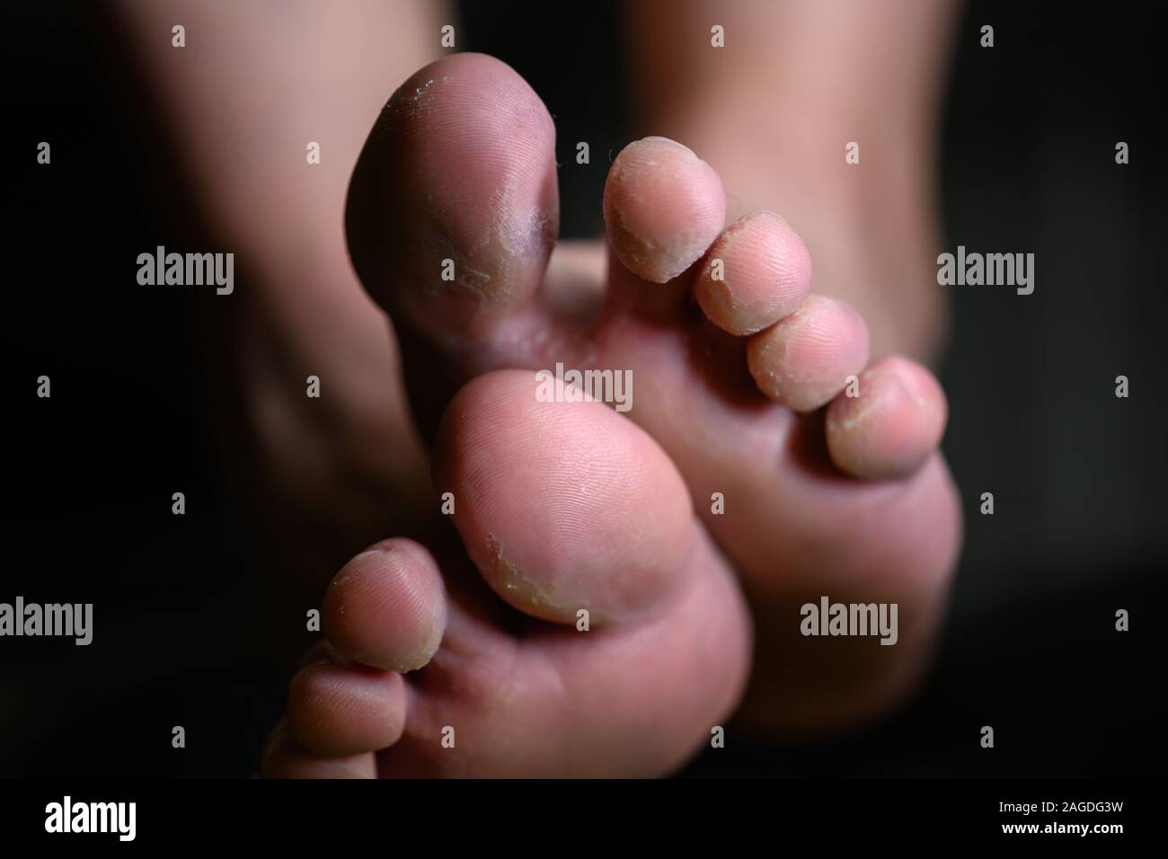 Close up of woman feet having tinea pedis althlete's fungus infection. Pathogenic infectious disease that can be easily acquired from contaminated flo Stock Photo