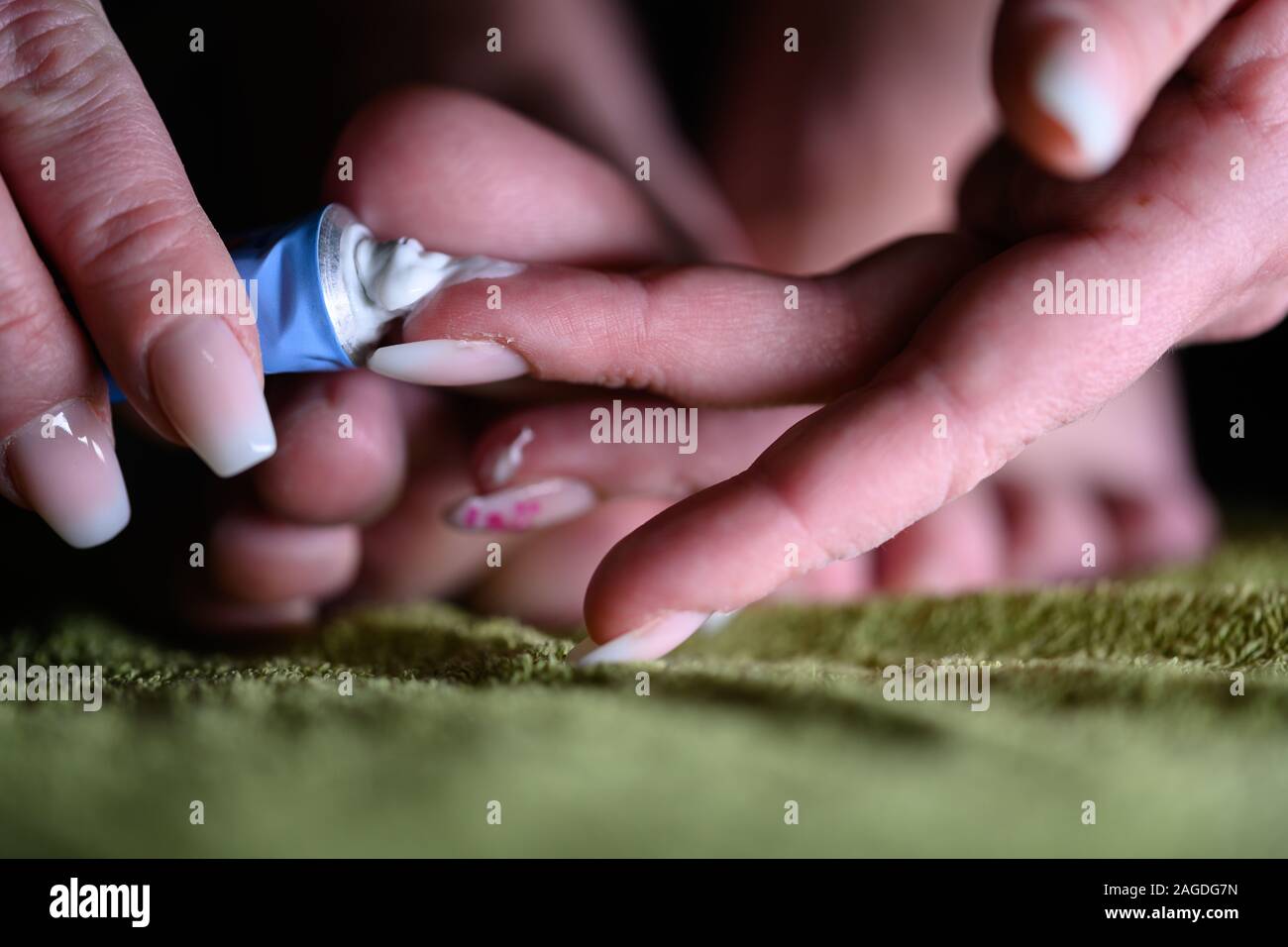 Fingers appling lotion on foot with fungal infection. Althele's foot can cause serious itching, blisters, reddness and smelly feets Stock Photo