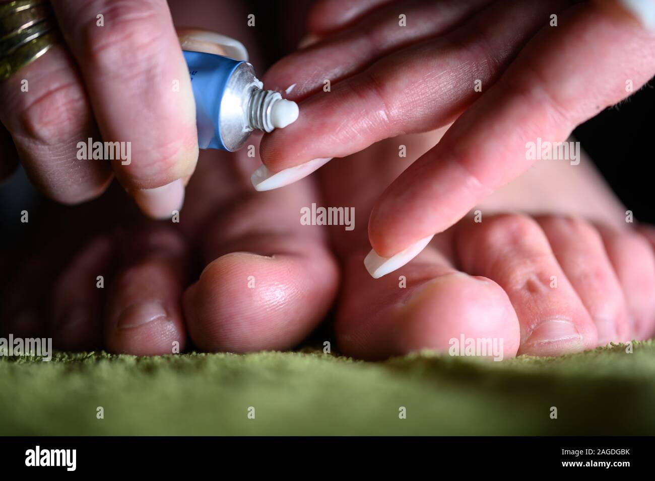 Fingers appling lotion on foot with fungal infection. Althele's foot can cause serious itching, blisters, reddness and smelly feets Stock Photo