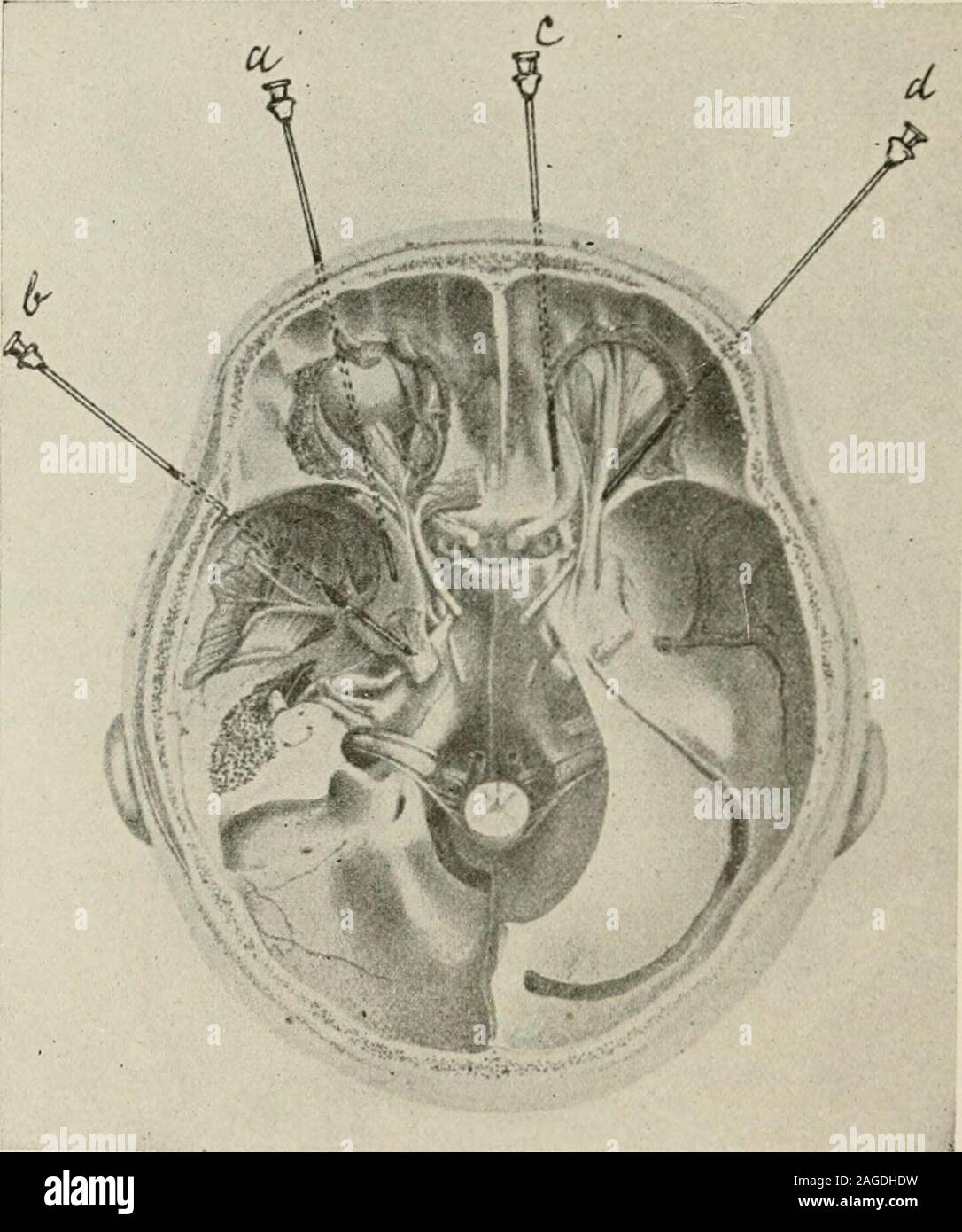 . Local and regional anesthesia; with chapters on spinal, epidural, paravertebral, and parasacral analgesia, and other applications of local and regional anesthesia to the surgery of the eye, ear, nose and throat, and to dental practice. Lachrymal tier. Fig. 172.—Scheme of the ophthalmic nerve after Corning. (Braun.) recurrent branch from the lacrimal artery to the dura, and theophthalmic vein. The relative position of these structures is seen in Fig. 170. 542 LOCAL ANESTHESLA. In making deep orbital injections for the purpose of blocking thosebranches of the trigeminus which pass through this Stock Photo