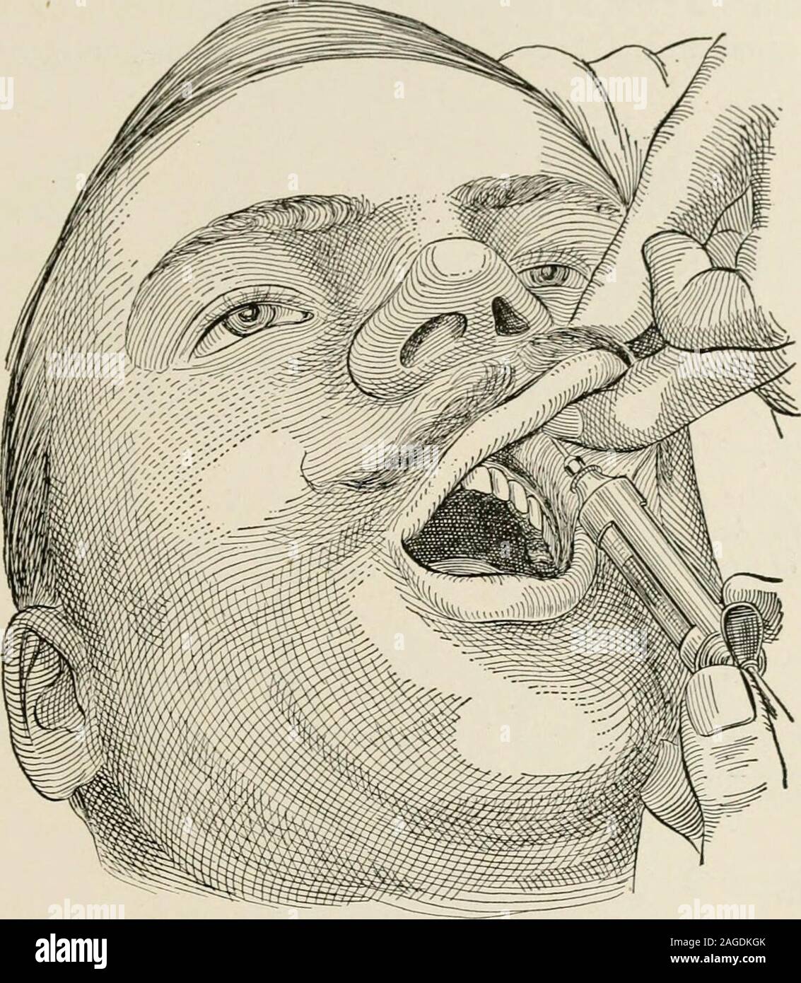 . Local and regional anesthesia; with chapters on spinal, epidural, paravertebral, and parasacral analgesia, and other applications of local and regional anesthesia to the surgery of the eye, ear, nose and throat, and to dental practice. Fig. 162.—The supra-orbital foramen is located at the junction of the inner andmiddle thirds of the supra-orbital margin; a line drawn from this point, passing betweenthe two bicuspids of the upper and lower jaw, should pass over the infra-orbital and men-tal foramina. (After Sobotta and McMurrich.) inner angle of the face; if a wall of anesthesia is now carri Stock Photo