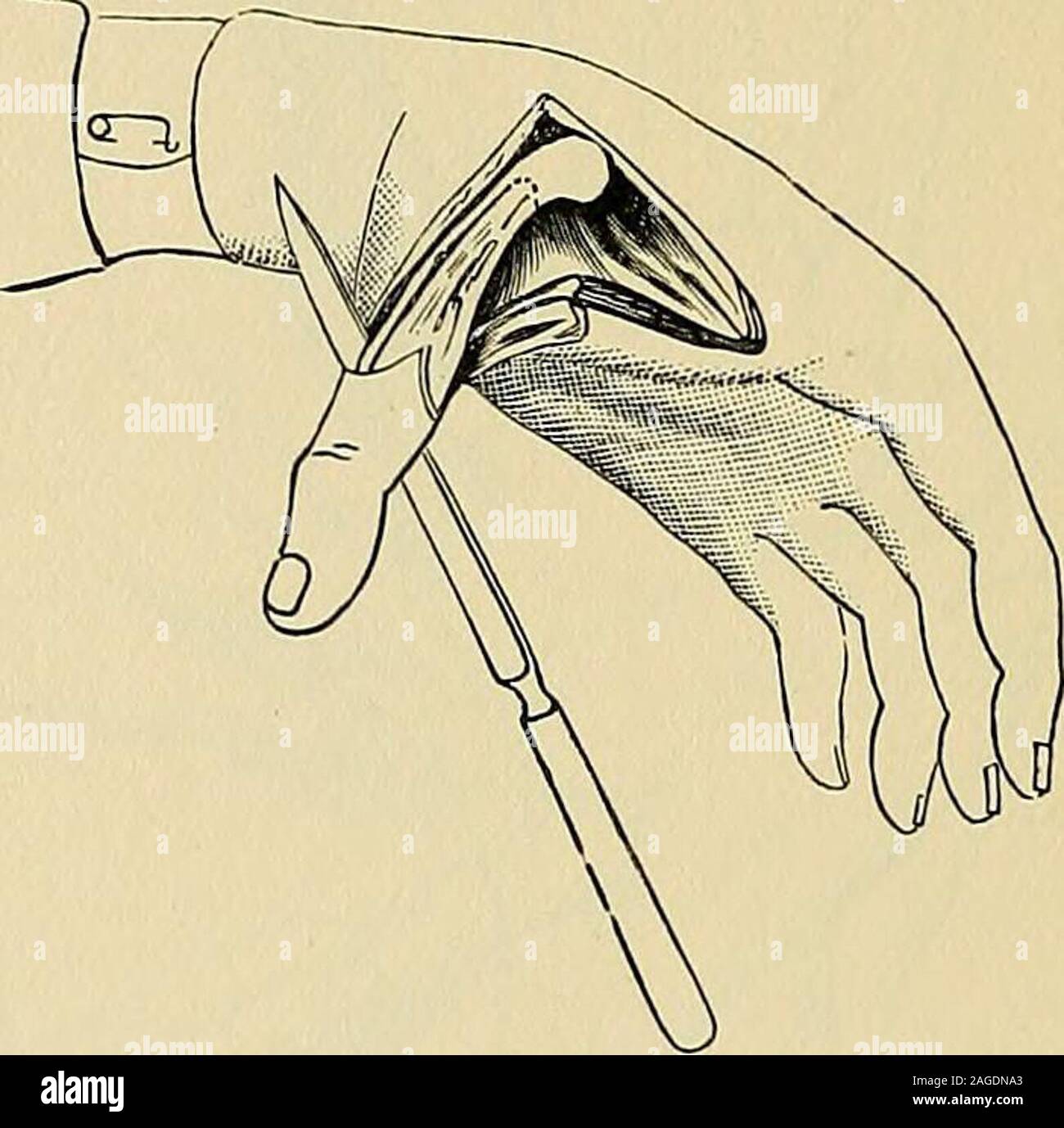 . Operative surgery. FiG. 518.—Lateralflap method. Fig. 519.—Making
