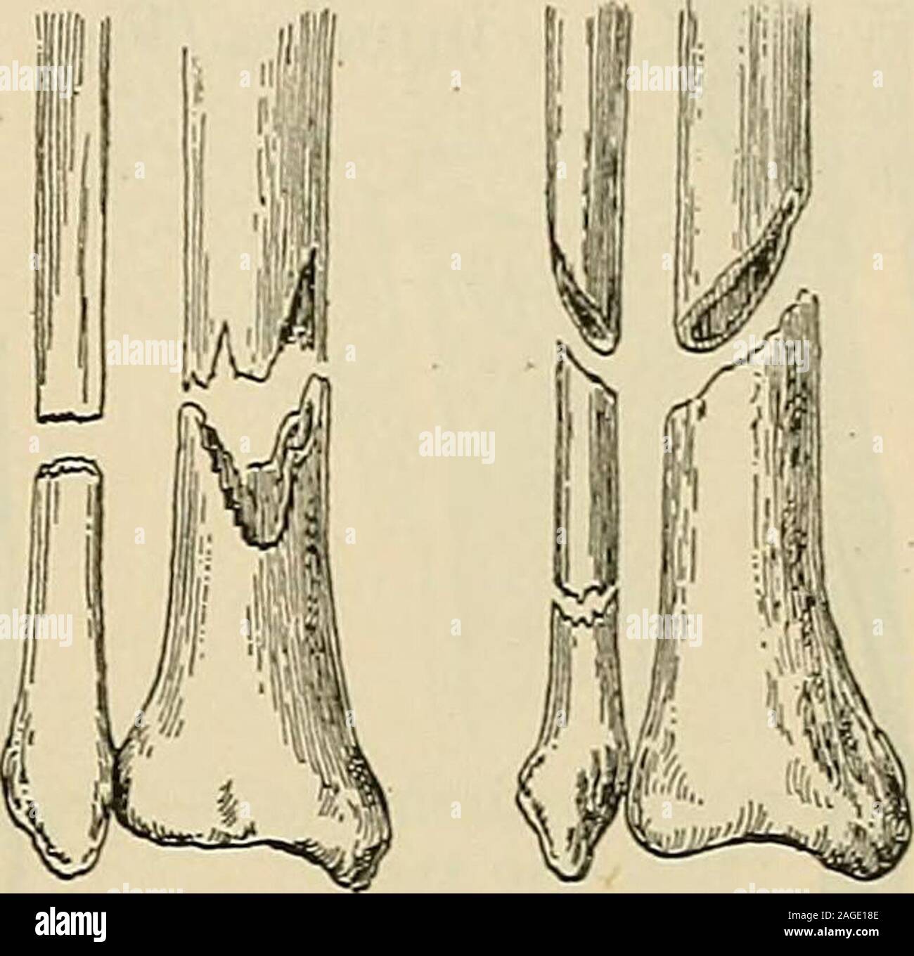 Modern Surgery General And Operative A B C Lt F Fig 298 Complete Fractures A Transverse H Spiral C Dentated D Oblique Or Multiple Meaning And Its Use Is No More Justifiable Than