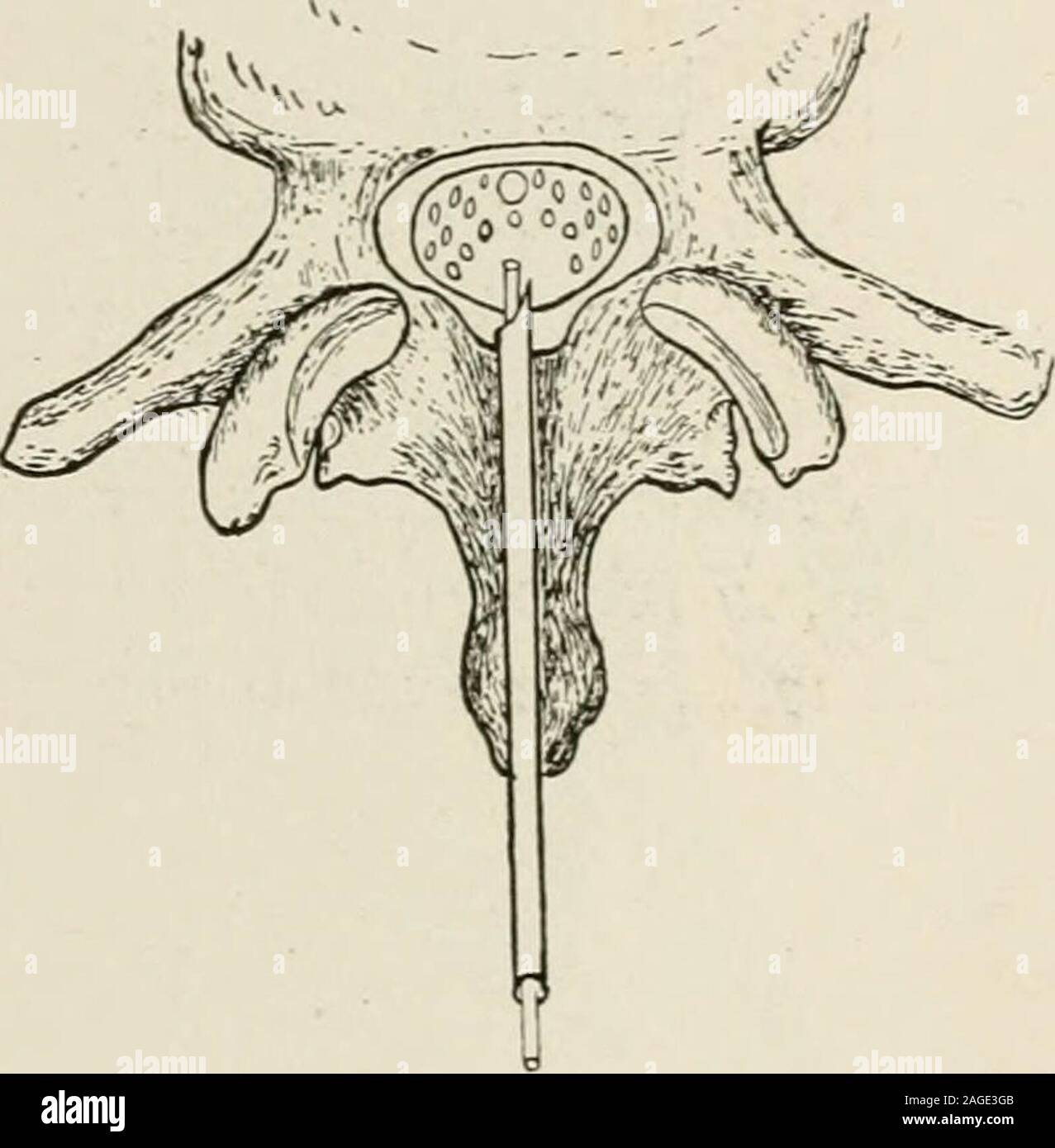 . Local and regional anesthesia; with chapters on spinal, epidural, paravertebral, and