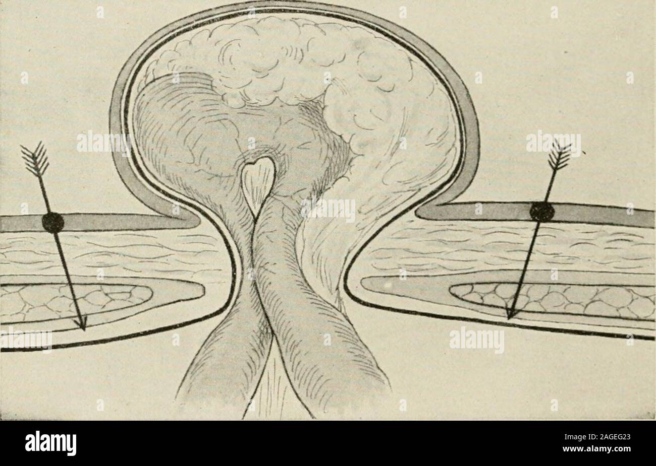 Omental adhesions hires stock photography and images Alamy