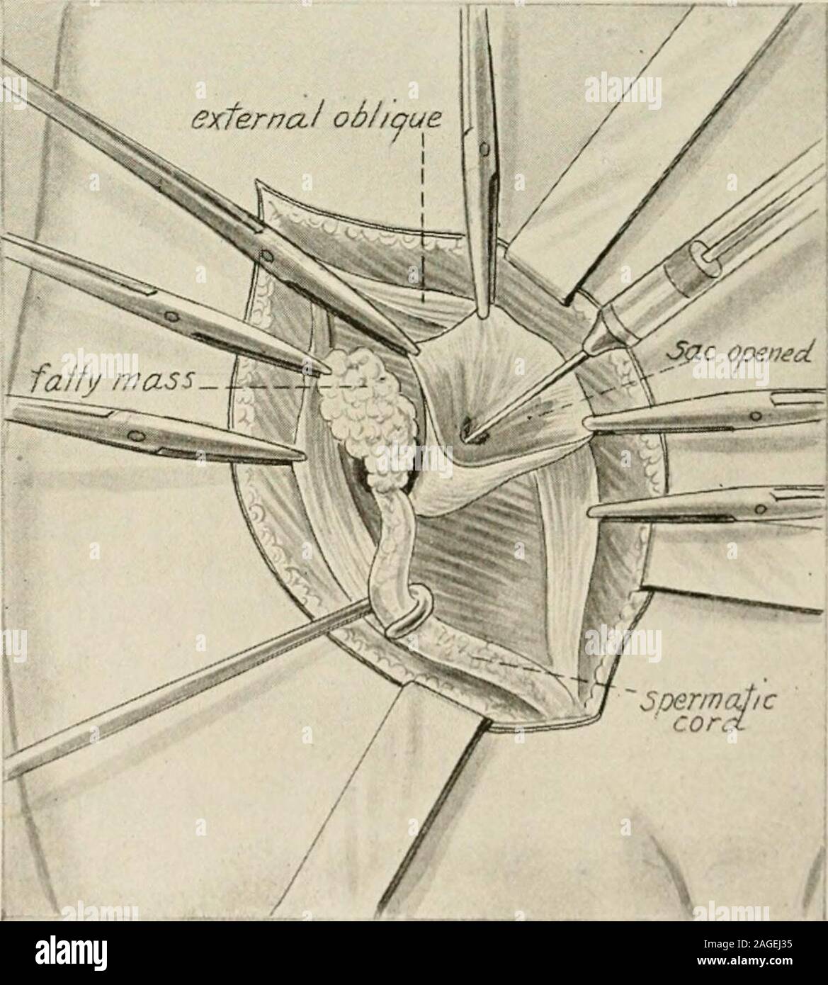 . Local and regional anesthesia; with chapters on spinal, epidural