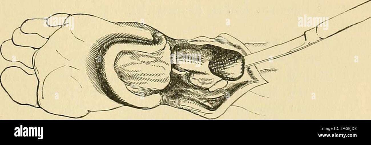 . Operative surgery. as much as possible ofthis bone be saved, as it