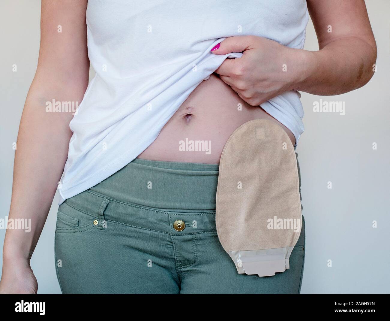Colostomy bag in skin color attached to young woman patient. Close