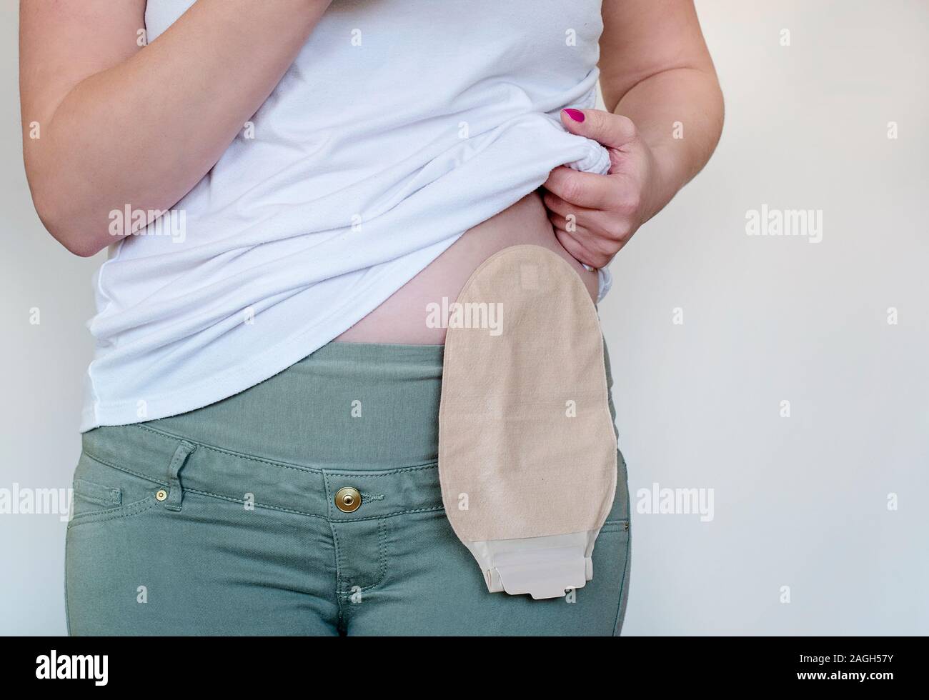 Mature man with stoma wearing transparent ileostomy bag. See image 2ARGPBT  for new, empty bag after changing Stock Photo - Alamy