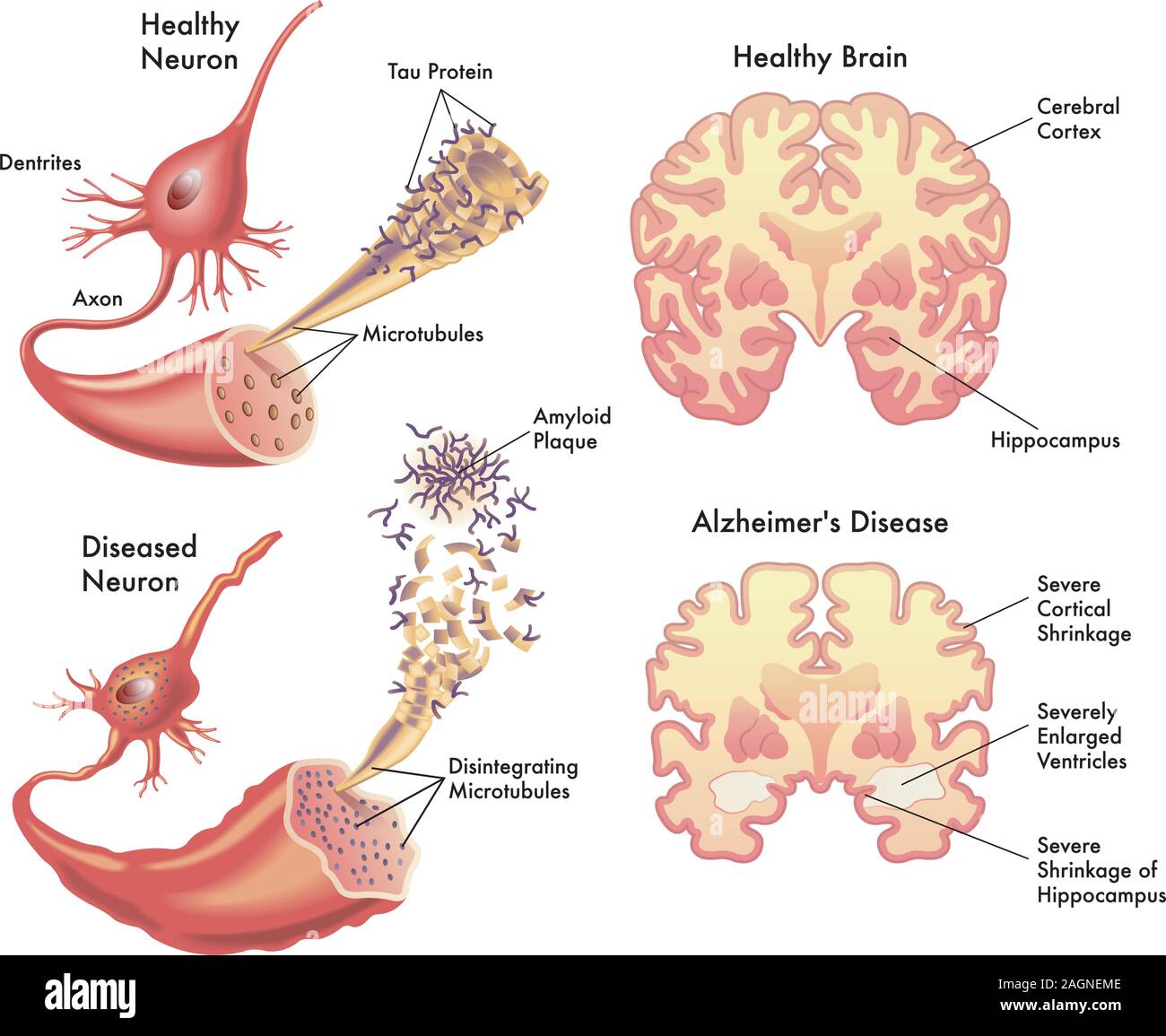 Medical illustration of the symptoms of Alzheimers disease. Stock Vector