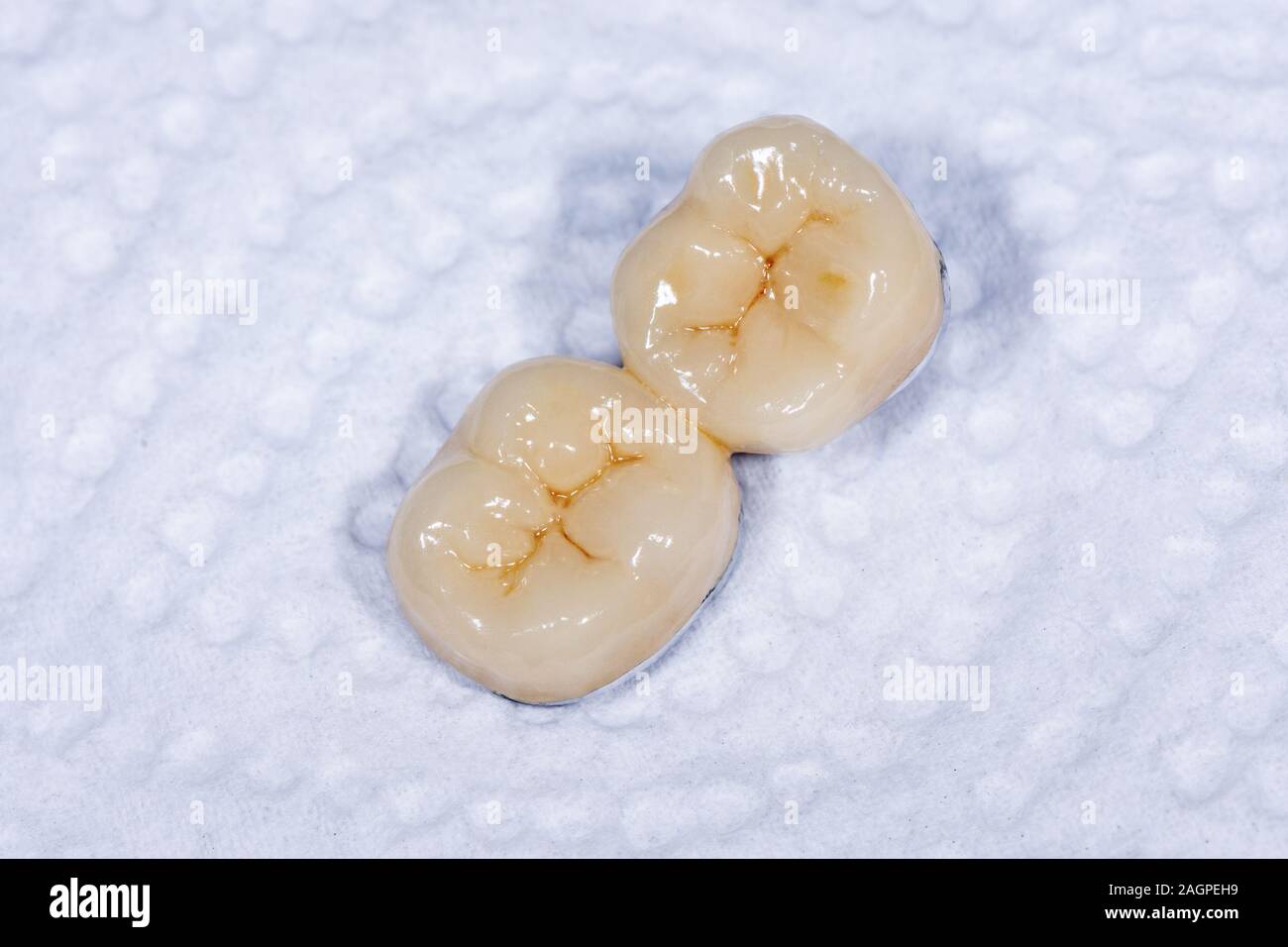 ceramicmetal crown, veneer closeup macro. Human a tooth molar