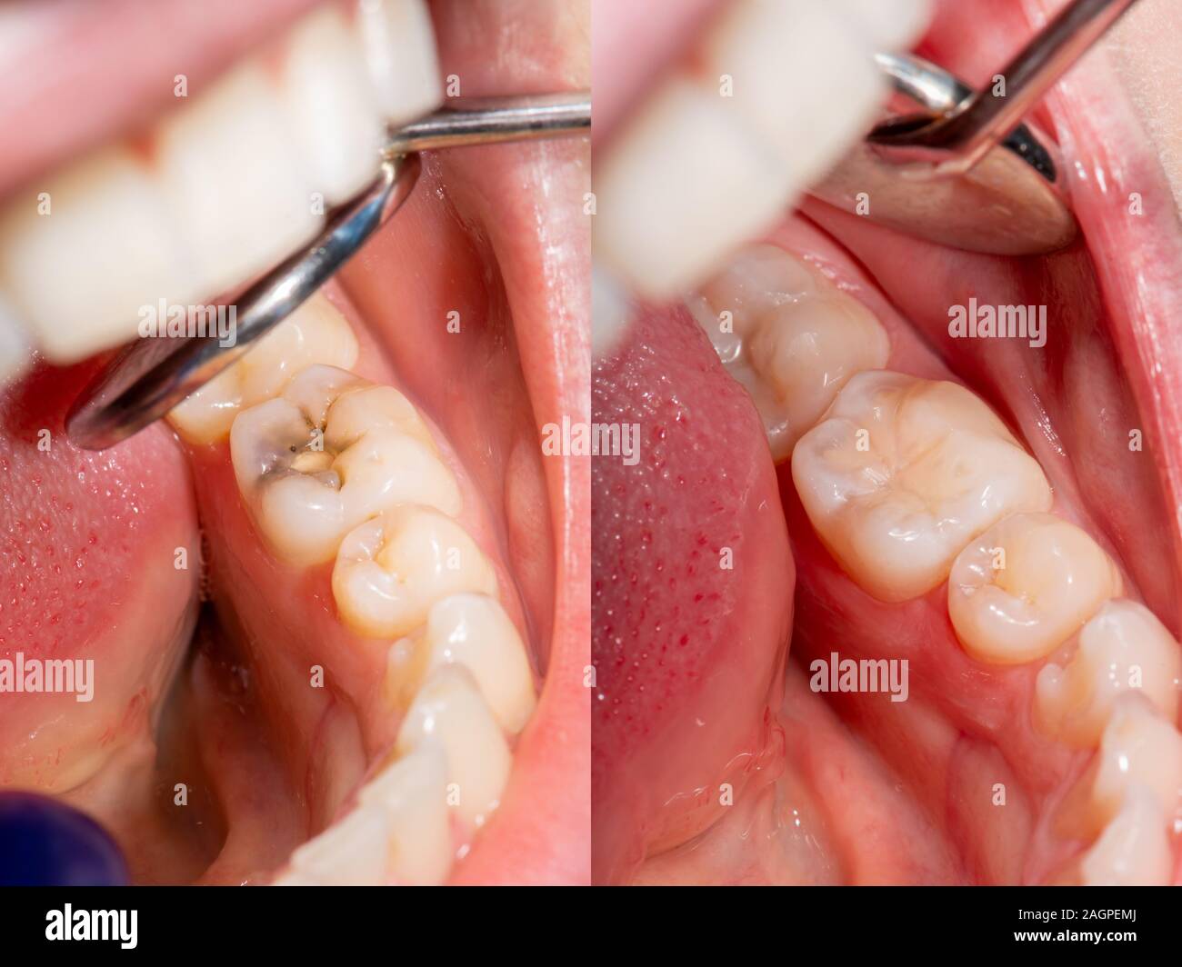 Dental caries. Filling with dental composite photopolymer material