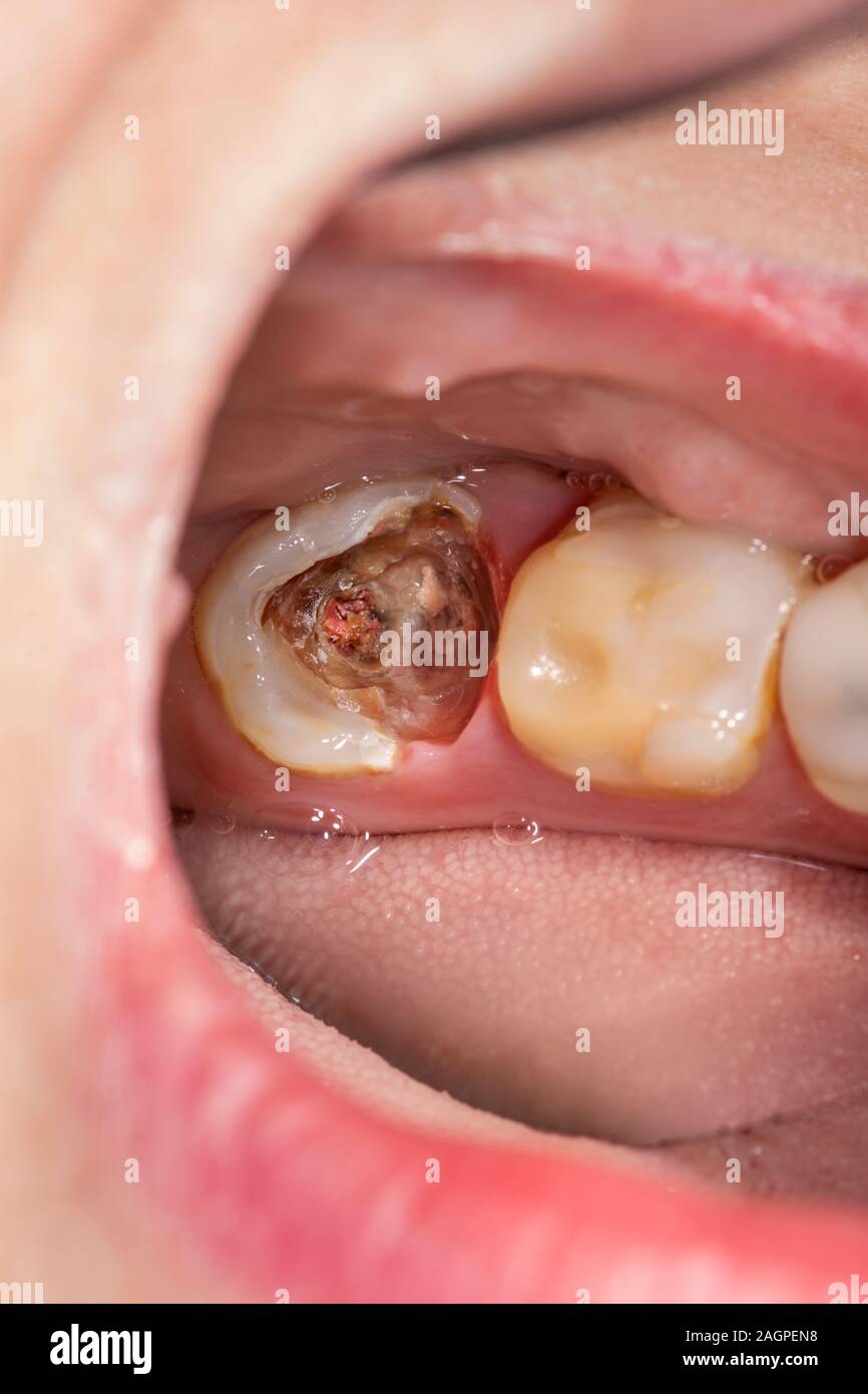 Dental caries. Filling with dental composite photopolymer material using Rubber Dam. The concept of dental treatment in a dental clinic Stock Photo