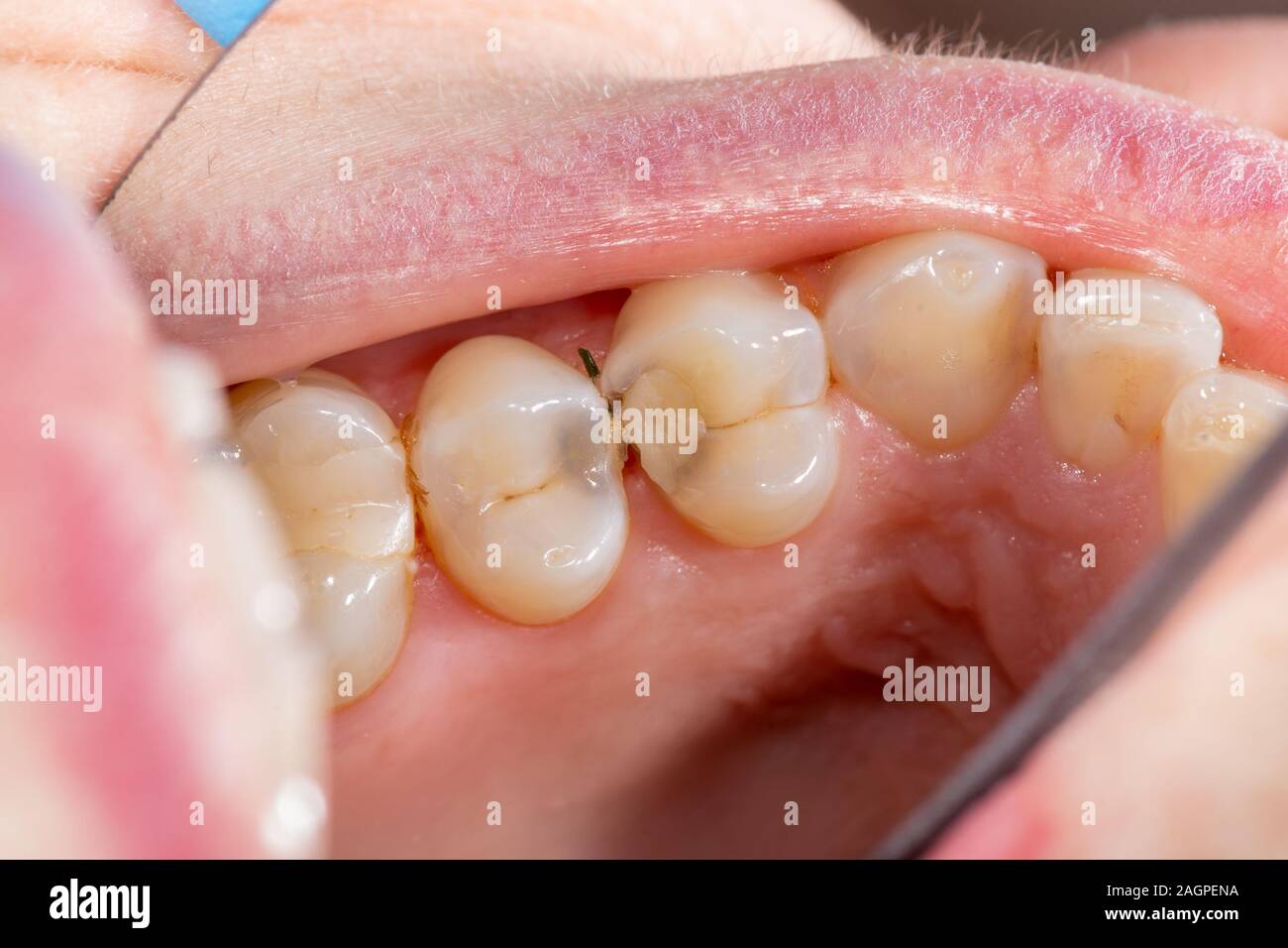 Dental caries. Filling with dental composite photopolymer material