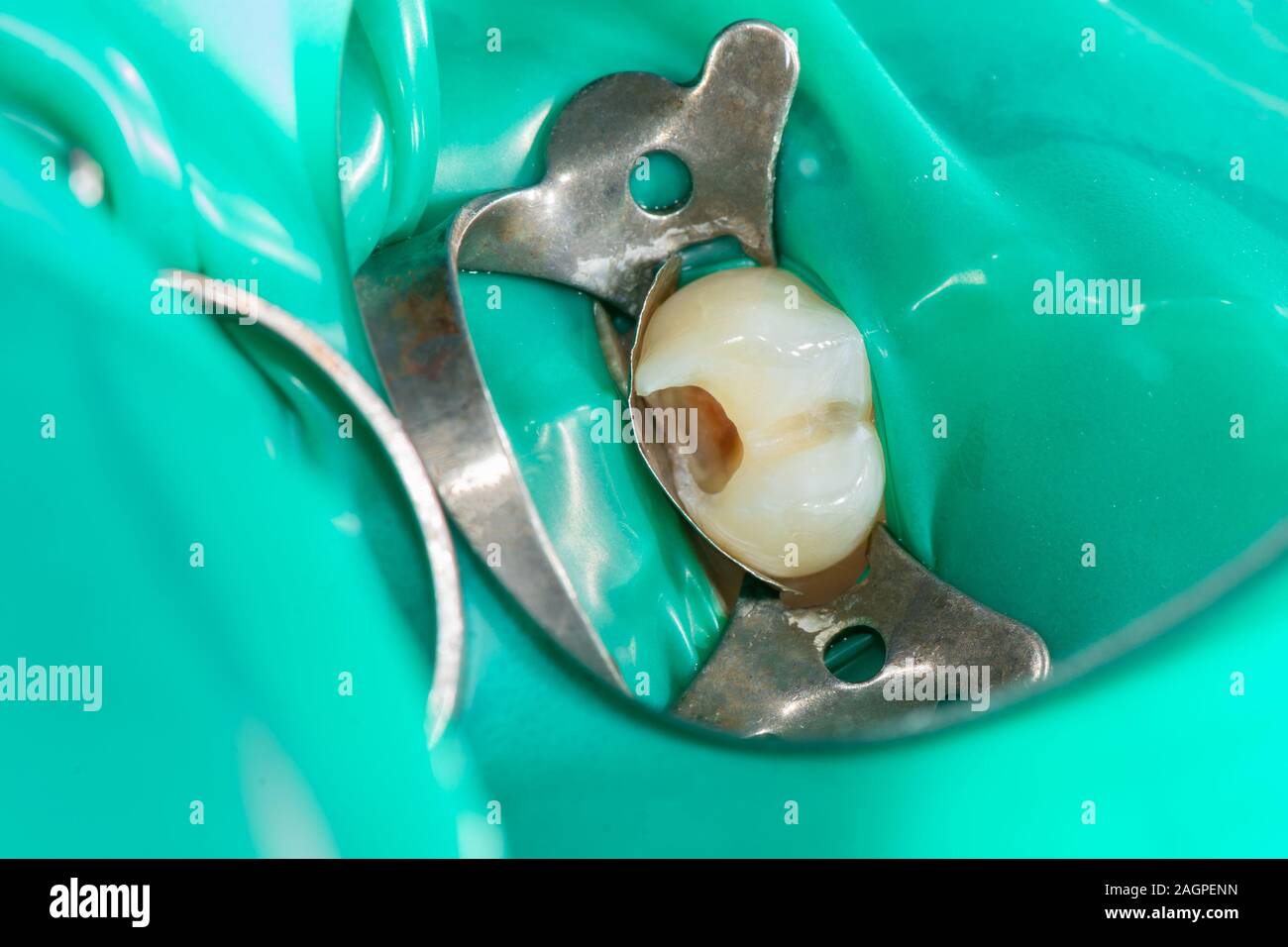Dental caries. Filling with dental composite photopolymer material
