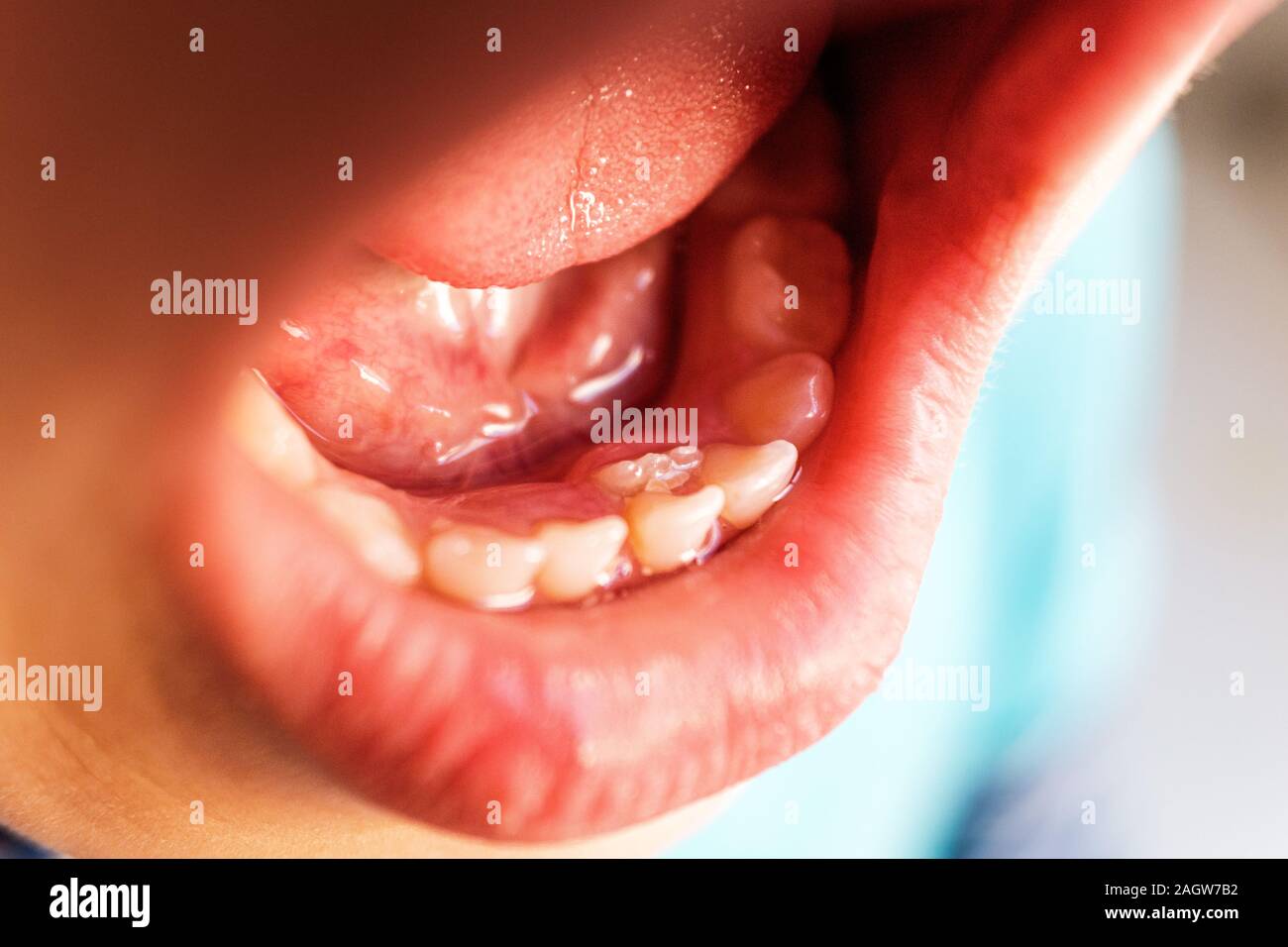 Children shark teeth, first tooth that appears in childhood behind baby